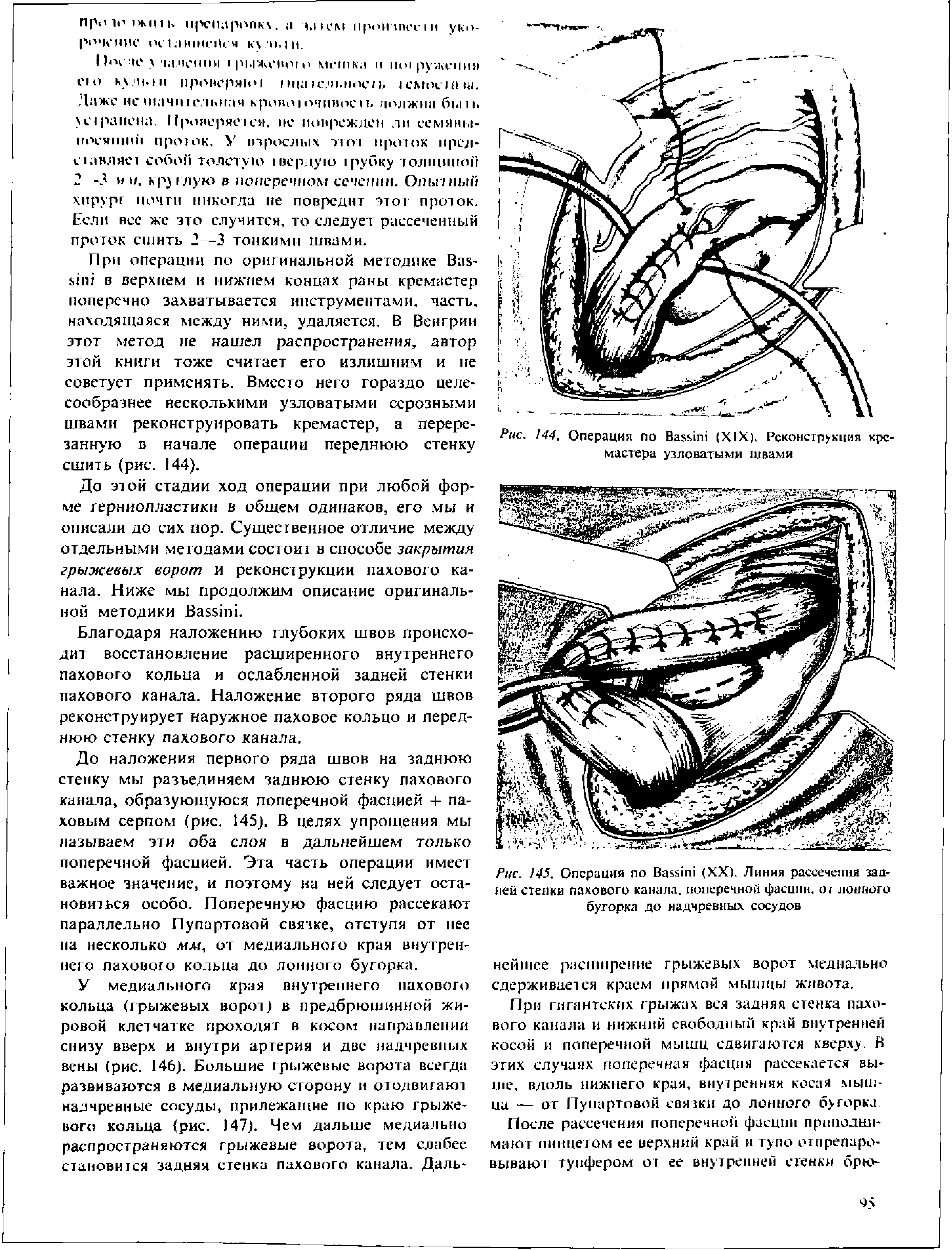 Рис. 45. Операция по B (XX). Линия рассечения задней стенки пахового канала, поперечной фасции, от лоиного бугорка до надчревных сосудов...