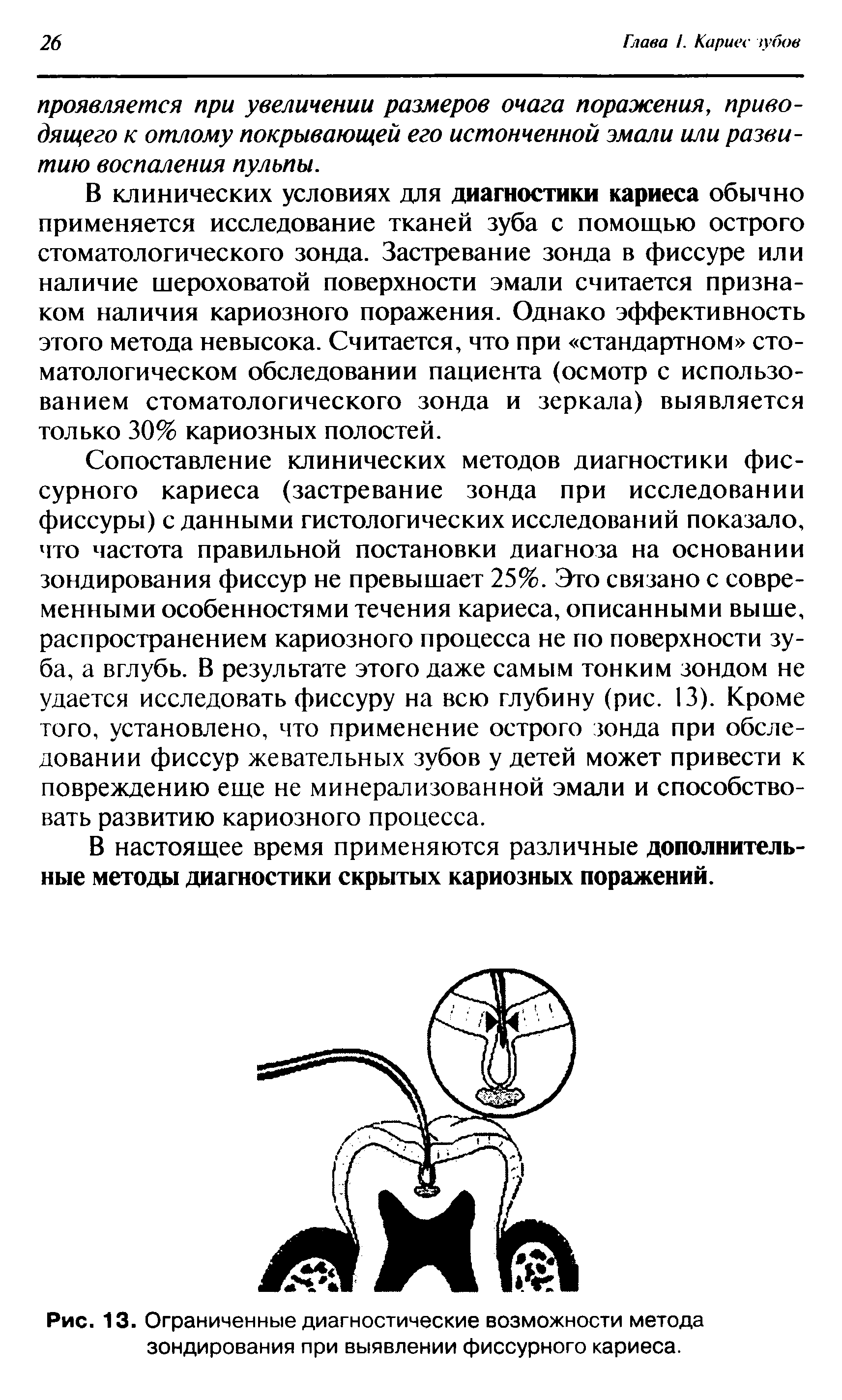 Рис. 13. Ограниченные диагностические возможности метода зондирования при выявлении фиссурного кариеса.