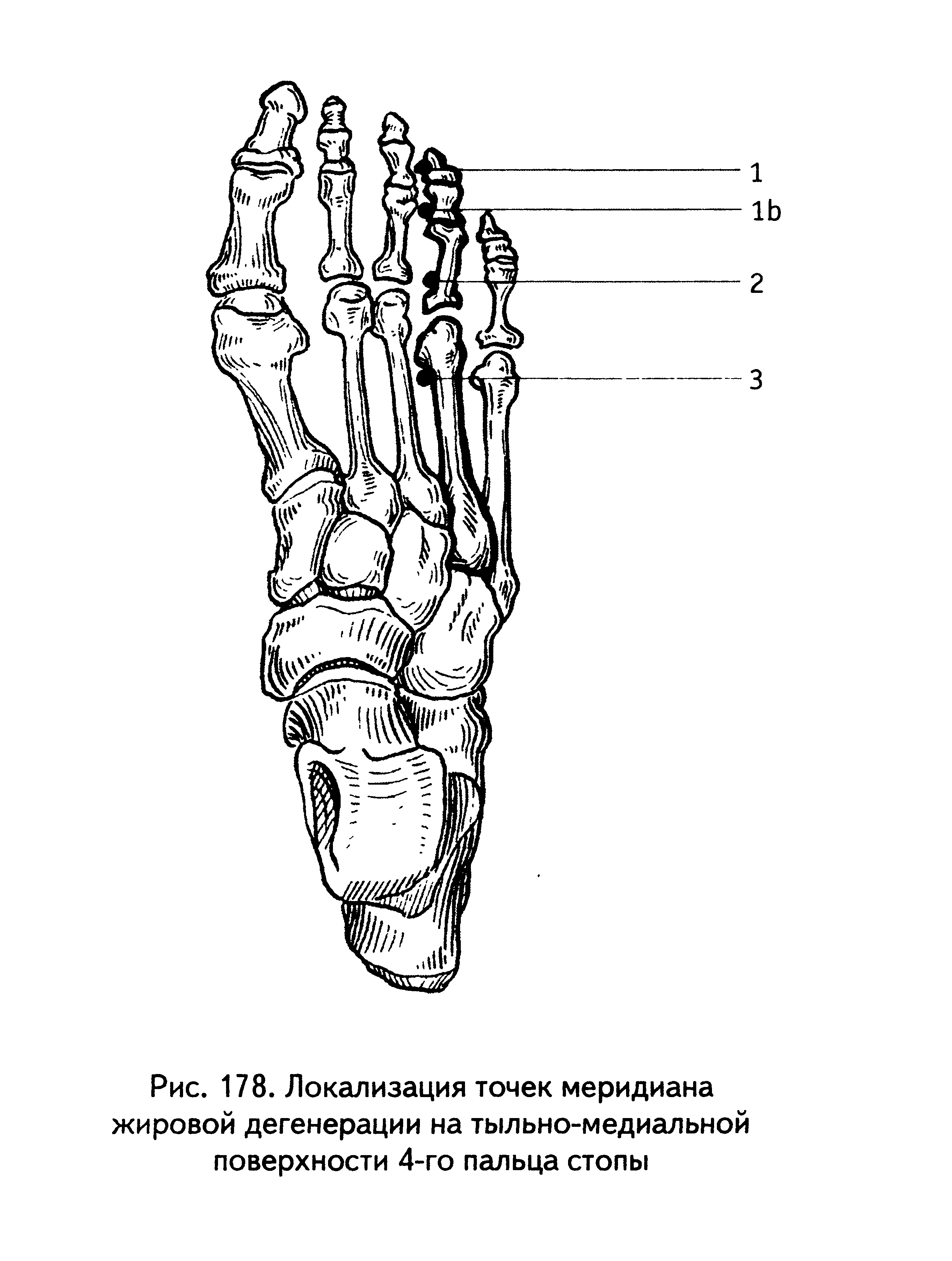 Рис. 178. Локализация точек меридиана жировой дегенерации на тыльно-медиальной поверхности 4-го пальца стопы...