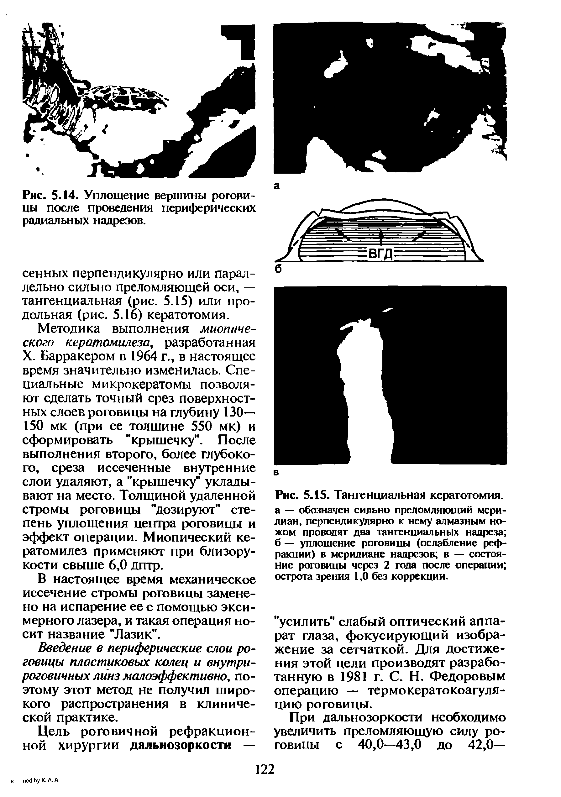 Рис. 5.15. Тангенциальная кератотомия, а — обозначен сильно преломляющий меридиан, перпендикулярно к нему алмазным ножом проводят два тангенциальных надреза б — уплощение роговицы (ослабление рефракции) в меридиане надрезов в — состояние роговицы через 2 года после операции острота зрения 1,0 без коррекции.