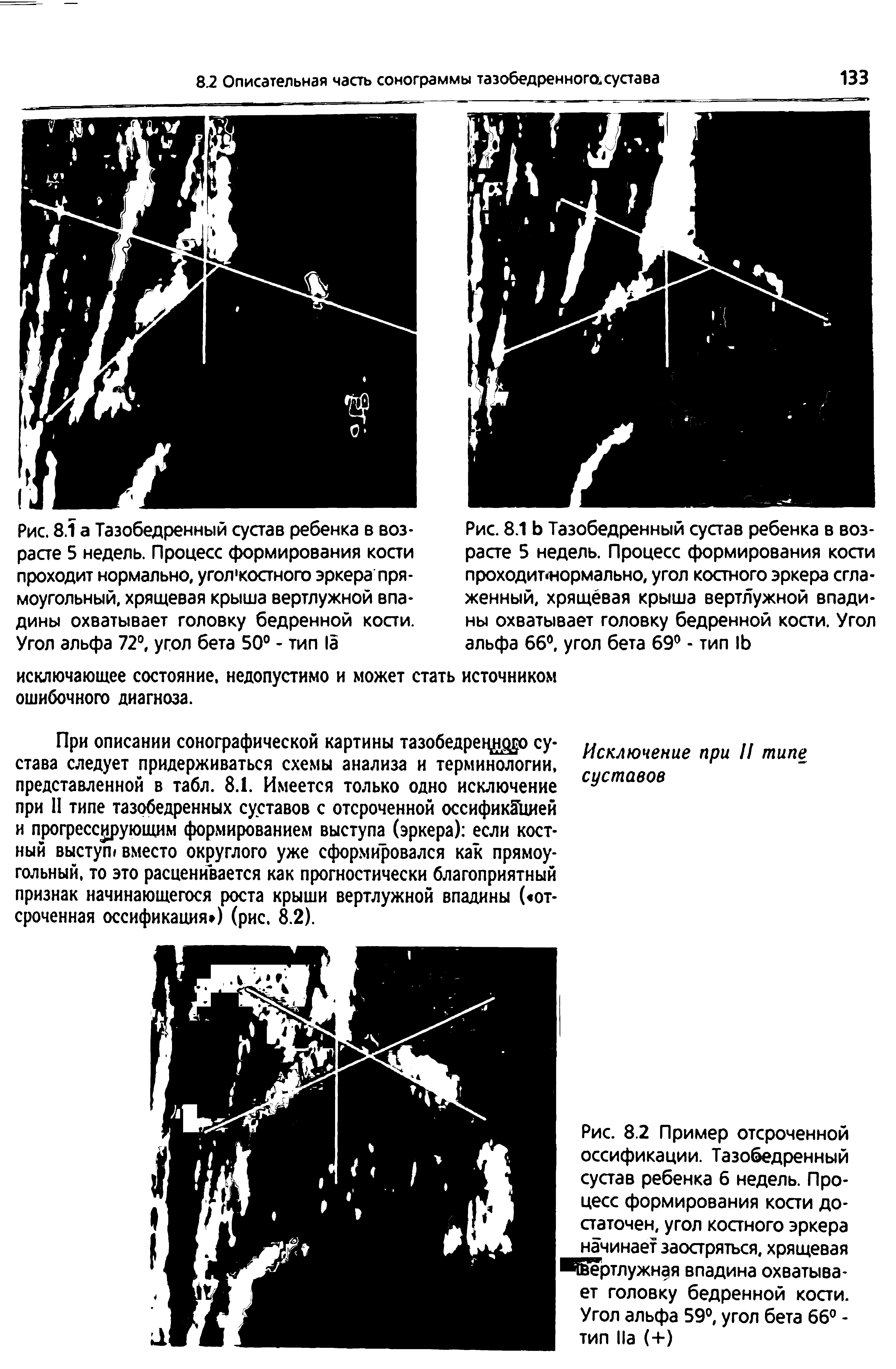 Рис. 8.1 Ь Тазобедренный сустав ребенка в возрасте 5 недель. Процесс формирования кости проходит<нормально, угол костного эркера сглаженный, хрящевая крыша вертлужной впадины охватывает головку бедренной кости. Угол альфа 66°, угол бета 69° - тип 1Ь...