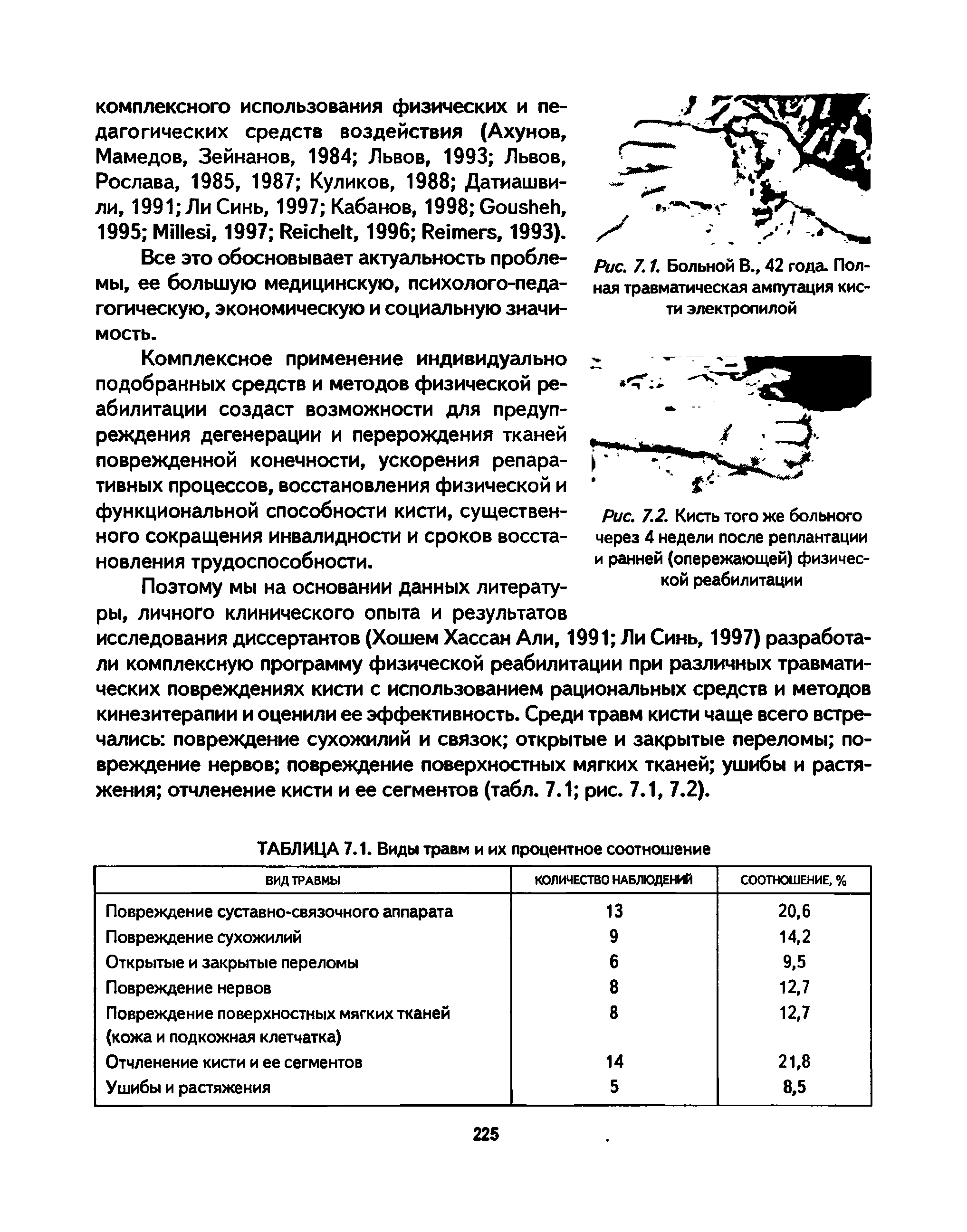 Рис. 7.1. Больной В., 42 года. Полная травматическая ампутация кисти электропилой...