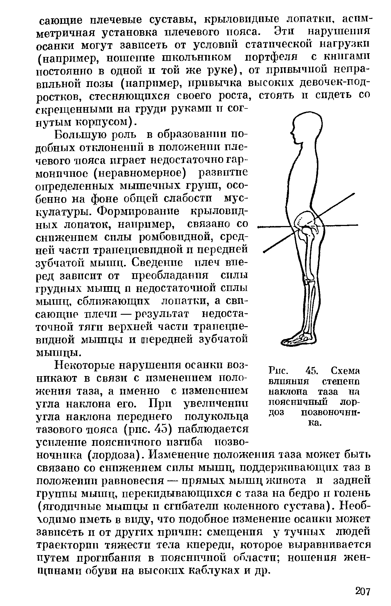 Рис. 45. Схема влияния степени наклона таза на поясничный лордоз позвоночника.