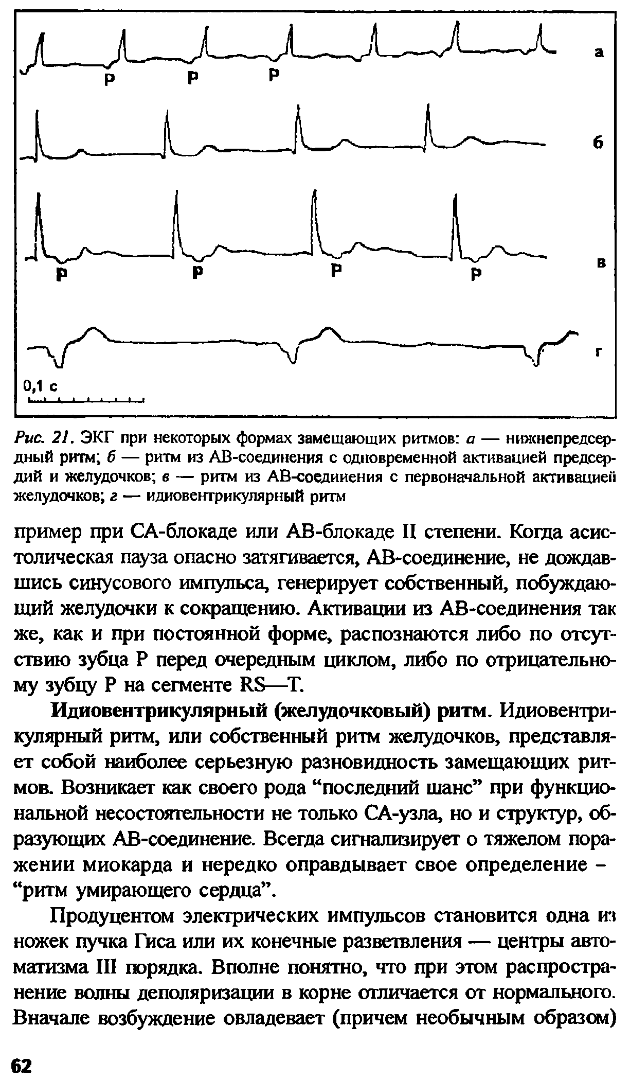 Рис. 21. ЭКГ при некоторых формах замещающих ритмов а — нижнепредсердный ритм б — ритм из АВ-соединения с одновременной активацией предсердий и желудочков в — ритм из АВ-соедииения с первоначальной активацией желудочков г — идиовентрикулярный ритм...