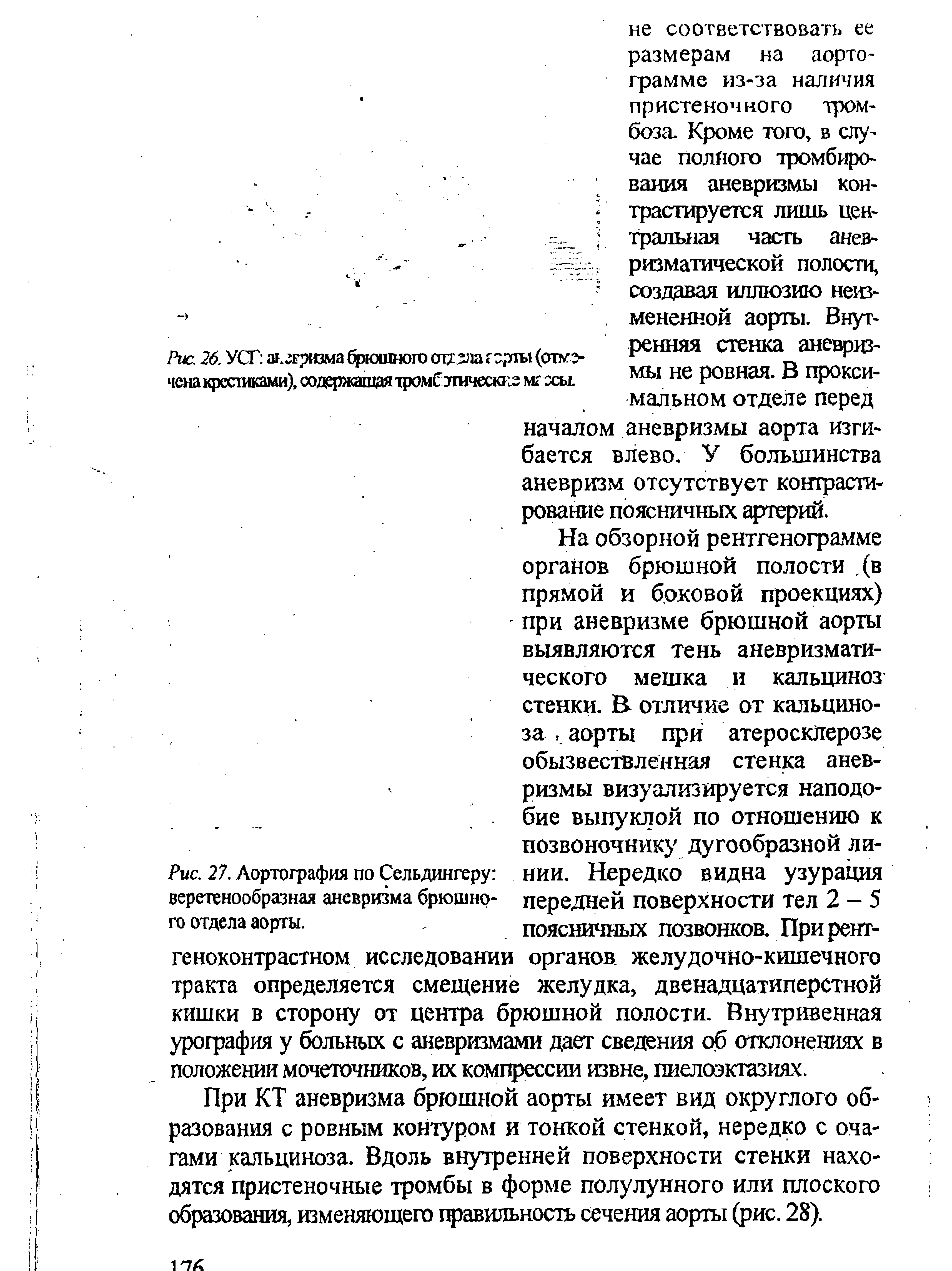 Рис. 27. Аортография по Сельдингеру веретенообразная аневризма брюшного отдела аорты.