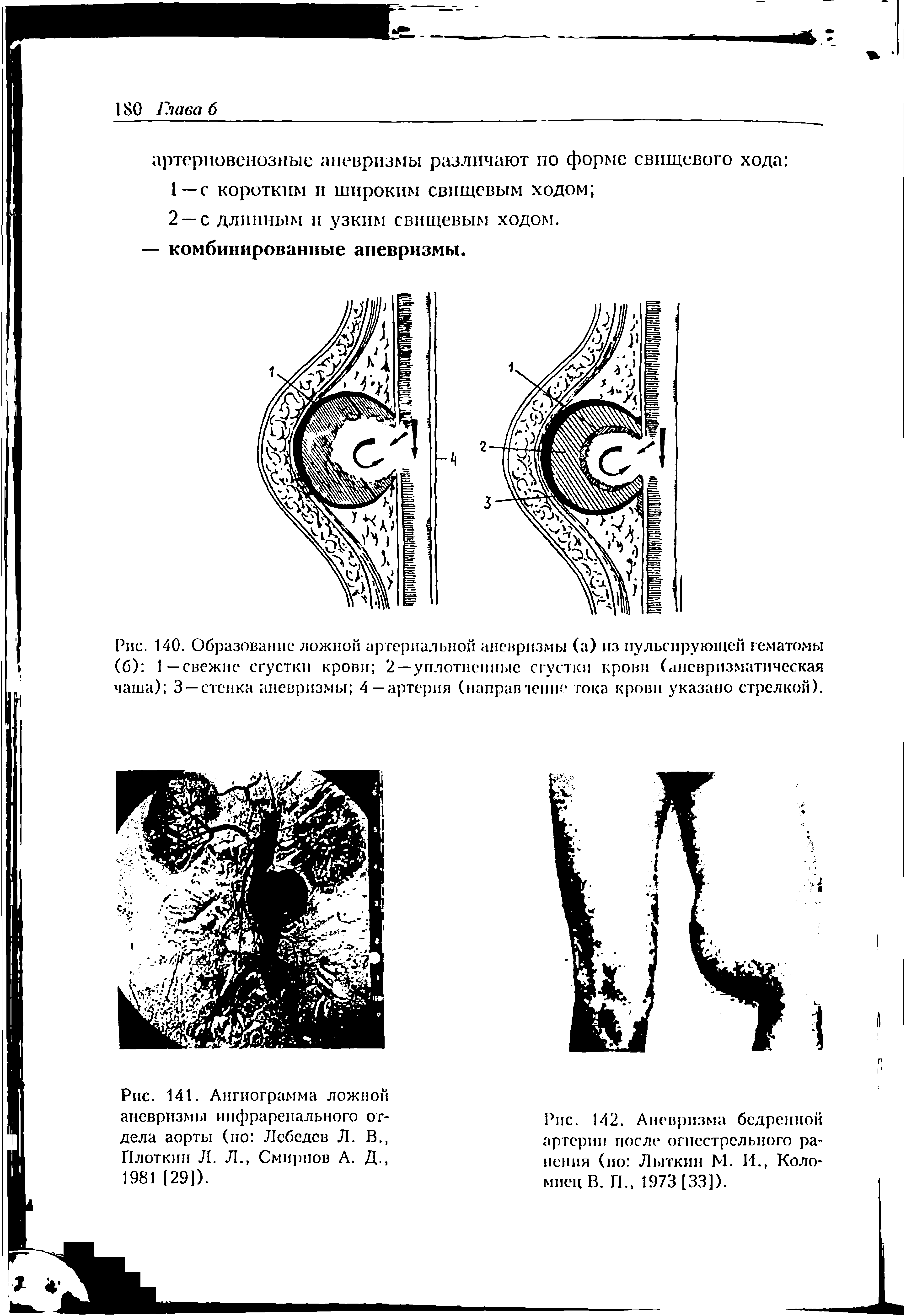 Рис. 142. Аневризма бедренной артерии после огнестрельного ранения (ио Лыткин М. И., Коломиец В. Г1. 1973 [33]).