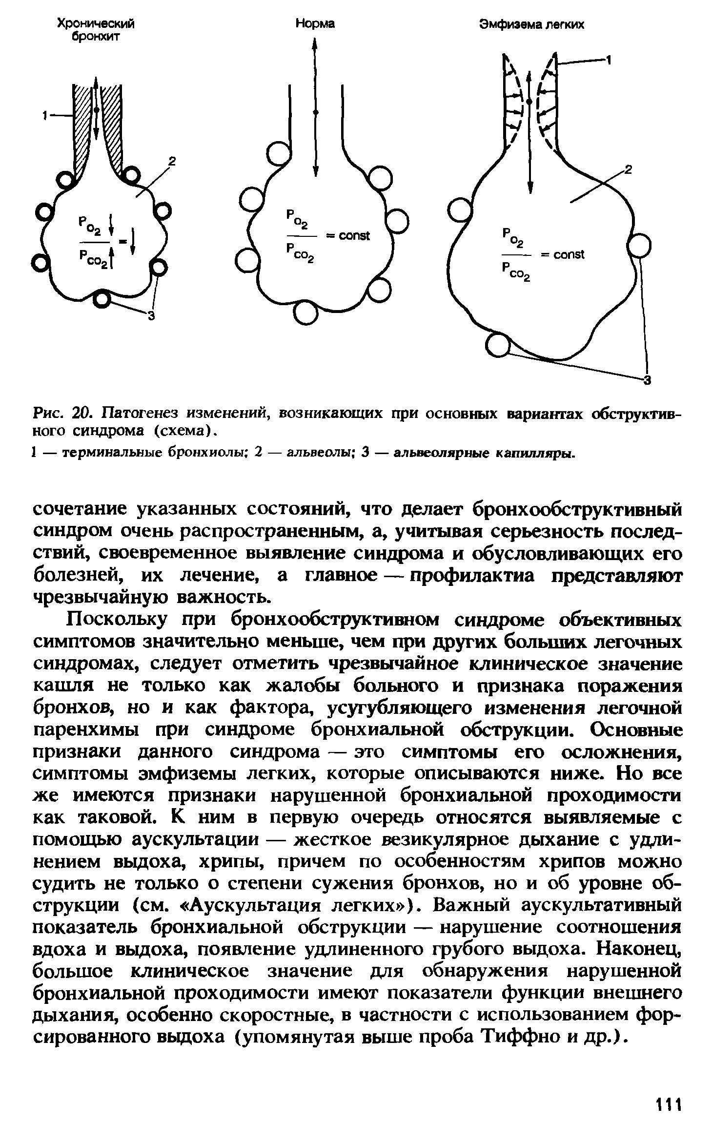 Рис. 20. Патогенез изменений, возникающих при основных вариантах обструктивного синдрома (схема).