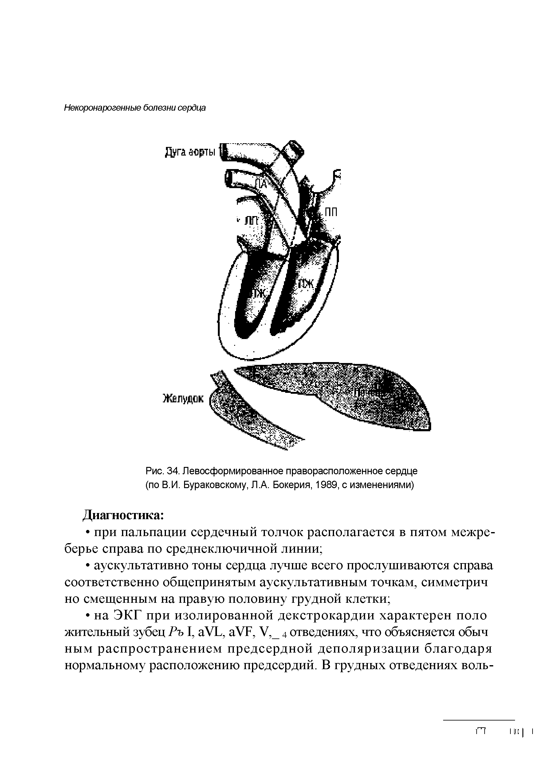 Рис. 34. Левосформированное праворасположенное сердце (по В.И. Бураковскому, Л.А. Бокерия, 1989, с изменениями)...