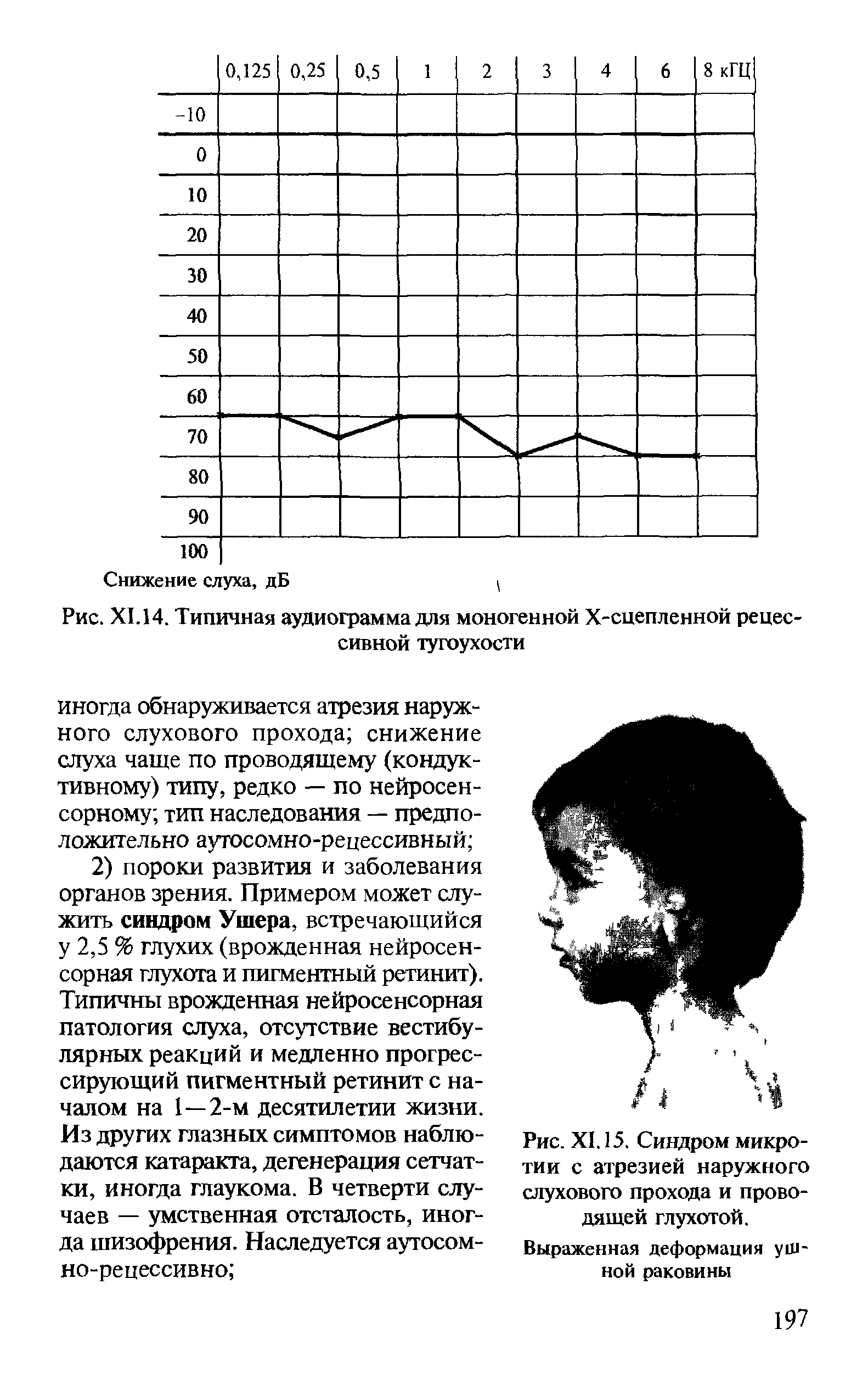 Рис. XI. 15. Синдром микро-тии с атрезией наружного слухового прохода и проводящей глухотой.