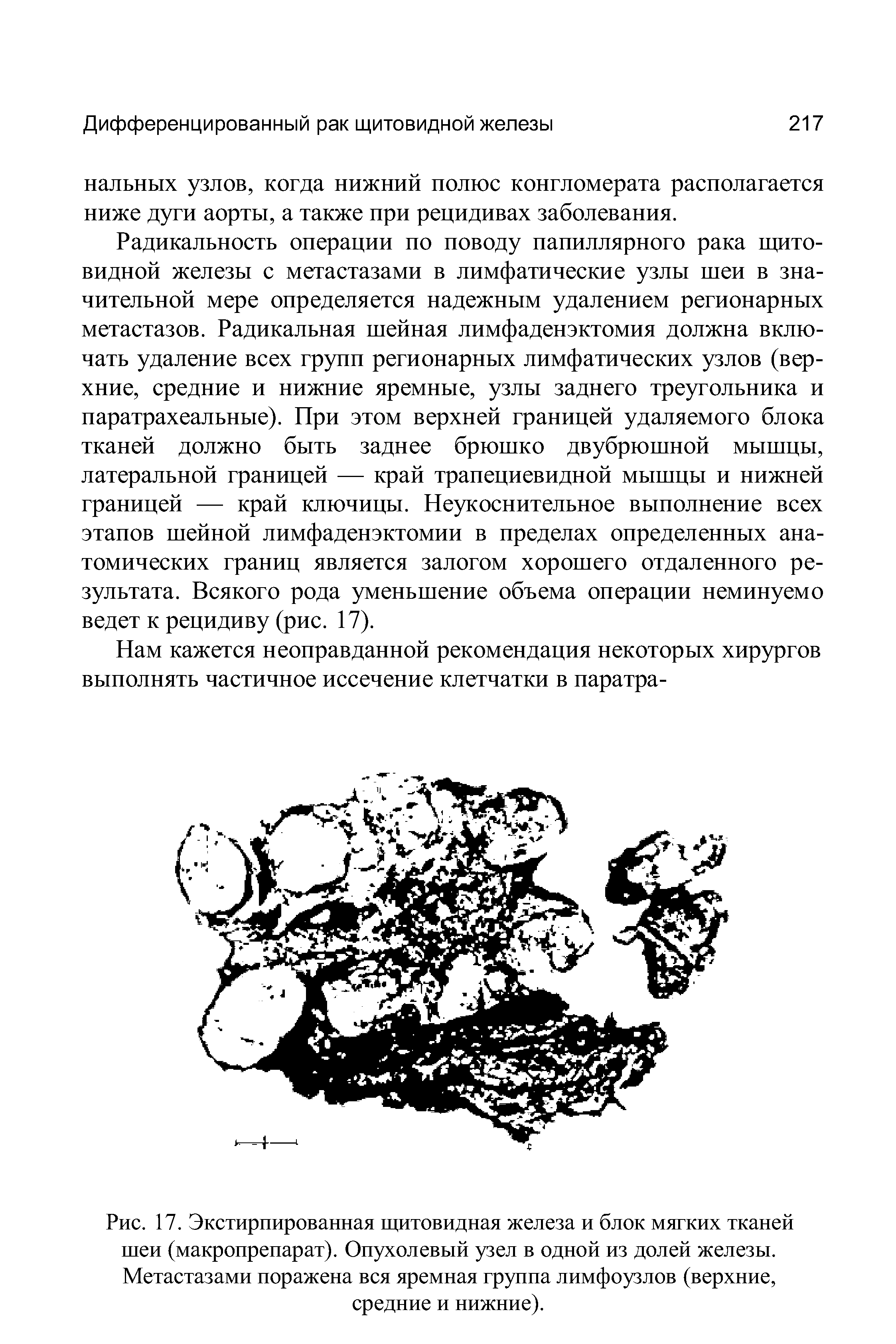 Рис. 17. Экстирпированная щитовидная железа и блок мягких тканей шеи (макропрепарат). Опухолевый узел в одной из долей железы. Метастазами поражена вся яремная группа лимфоузлов (верхние, средние и нижние).