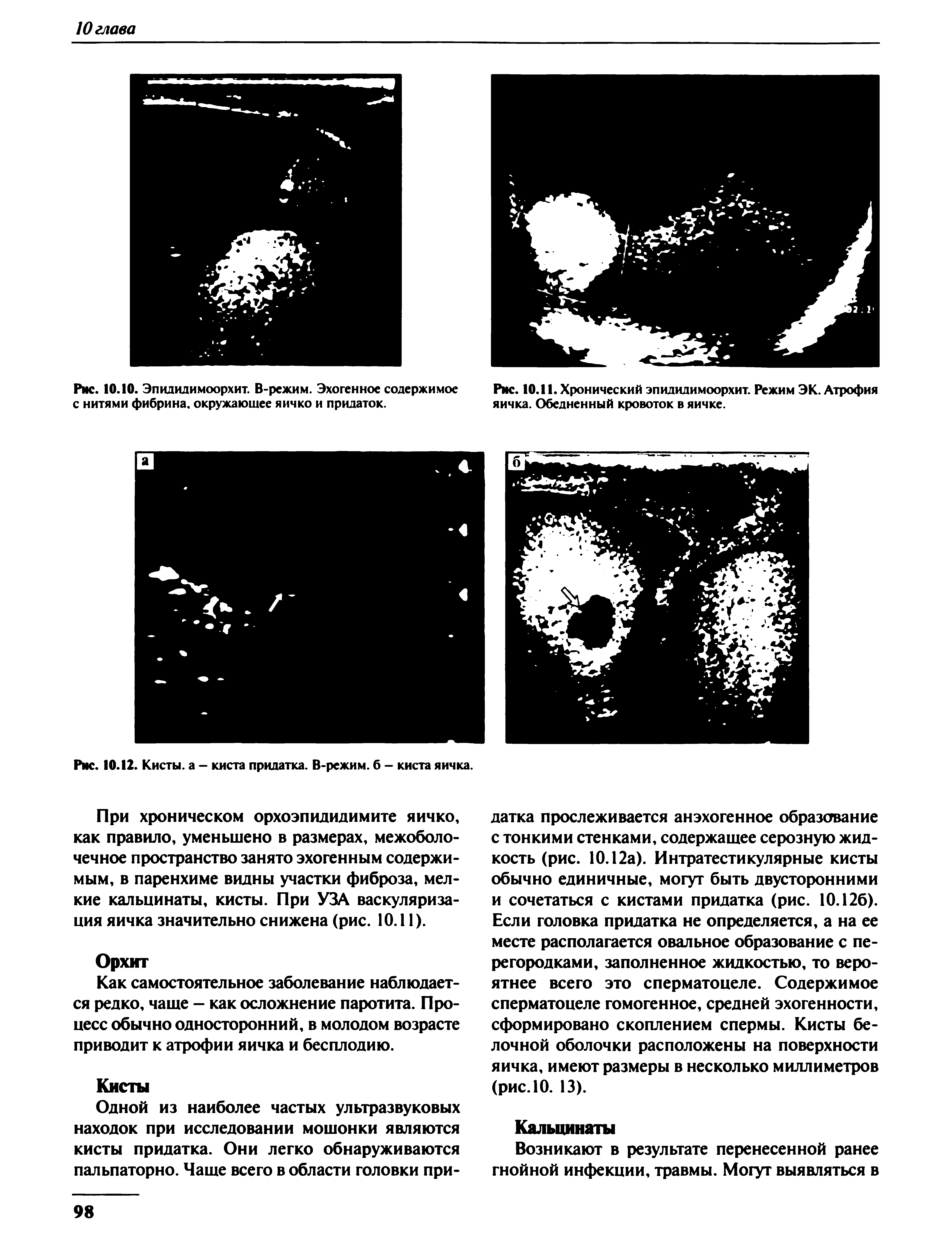 Рис. 10.12. Кисты, а - киста придатка. В-режим. б - киста яичка.