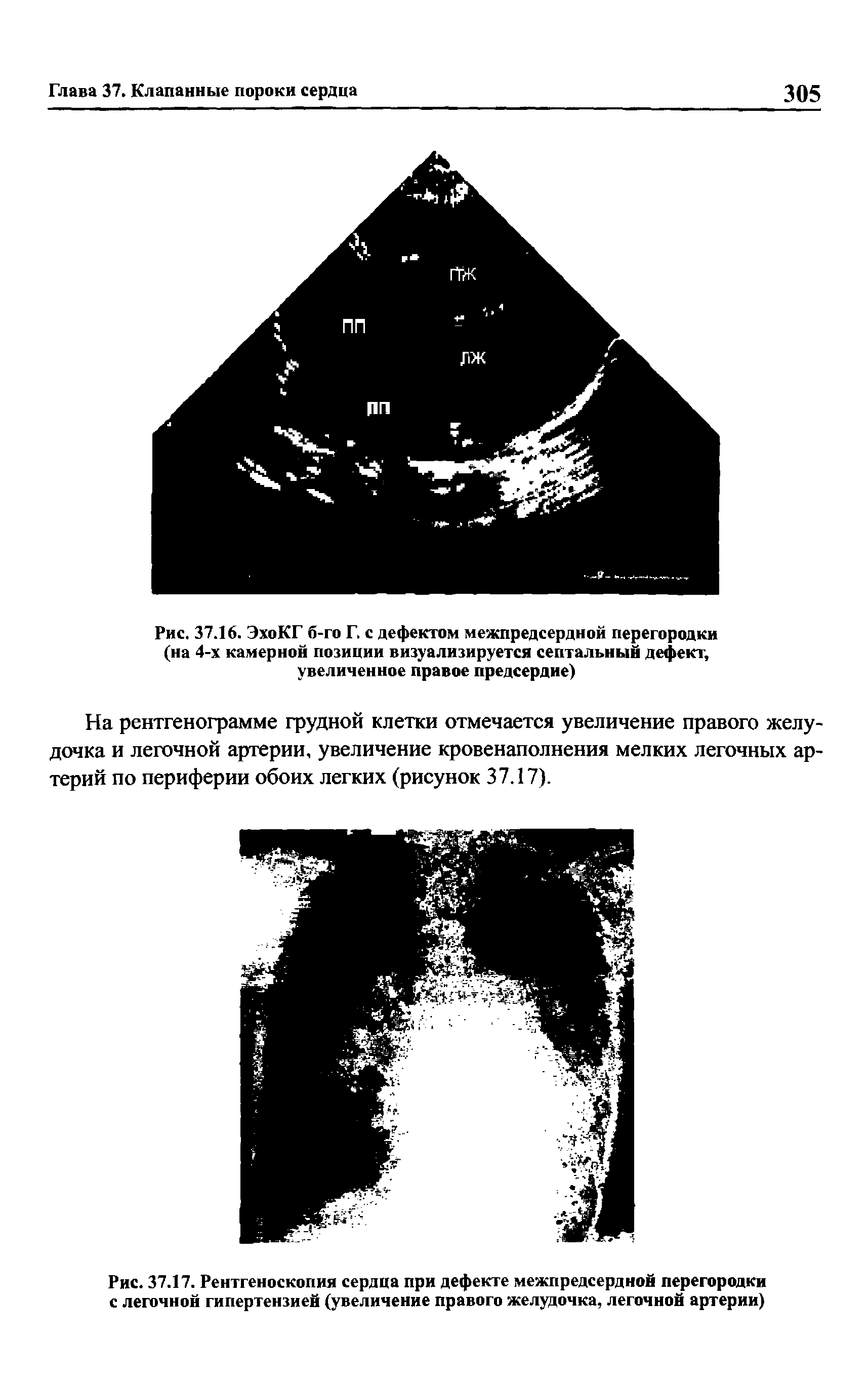 Рис. 37.17. Рентгеноскопия сердца при дефекте межпредсердной перегородки с легочной гипертензией (увеличение правого желудочка, легочной артерии)...