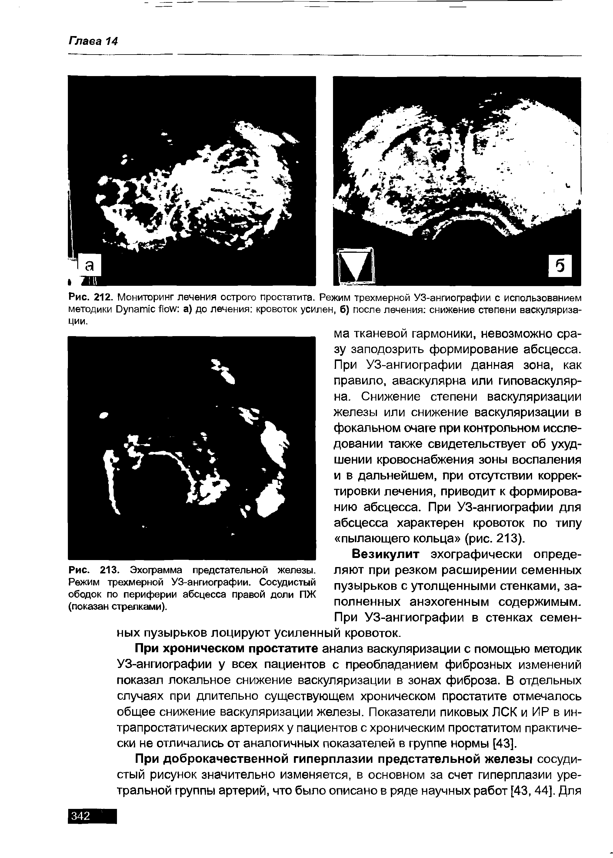 Рис. 212. Мониторинг лечения острого простатита. Режим трехмерной УЗ-ангиографии с использованием методики D а) до лечения кровоток усилен, б) после лечения снижение степени васкуляризации.