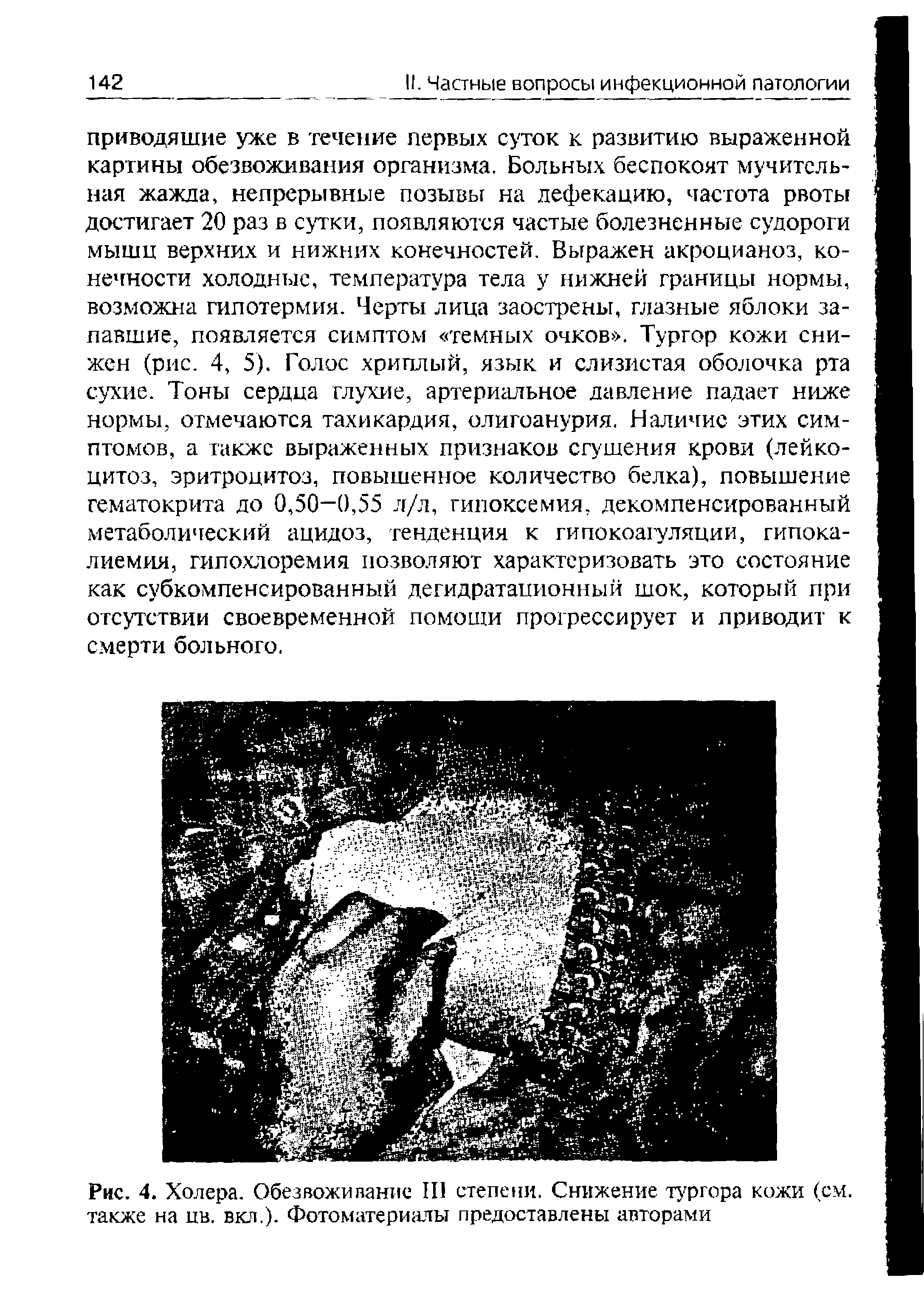 Рис. 4. Холера. Обезвоживание III степени. Снижение тургора кожи (см. также на пв. во.). Фотоматериалы предоставлены авторами...