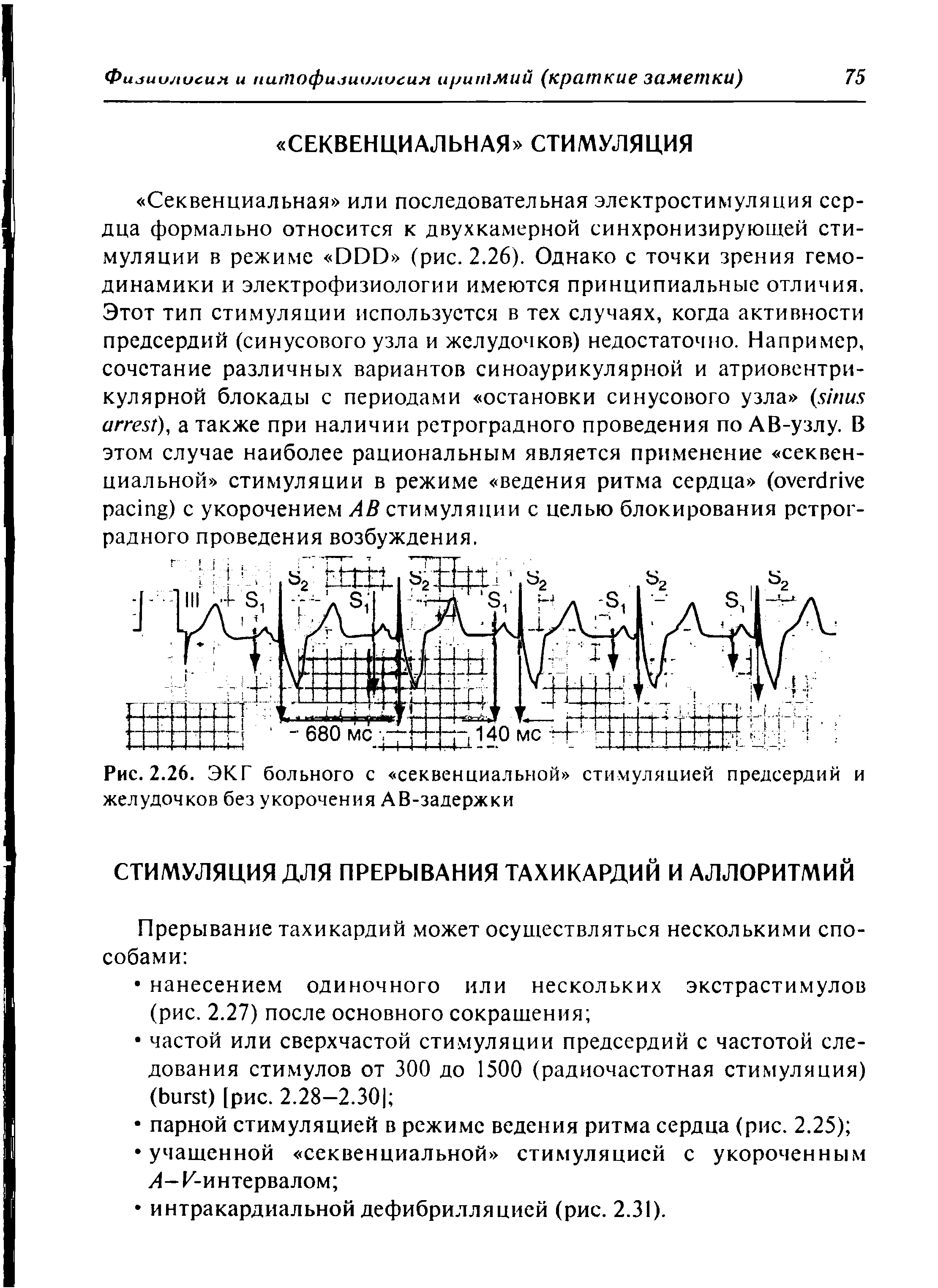 Рис. 2.26. ЭКГ больного с секвенциальной стимуляцией предсердий и желудочков без укорочения АВ-задержки...