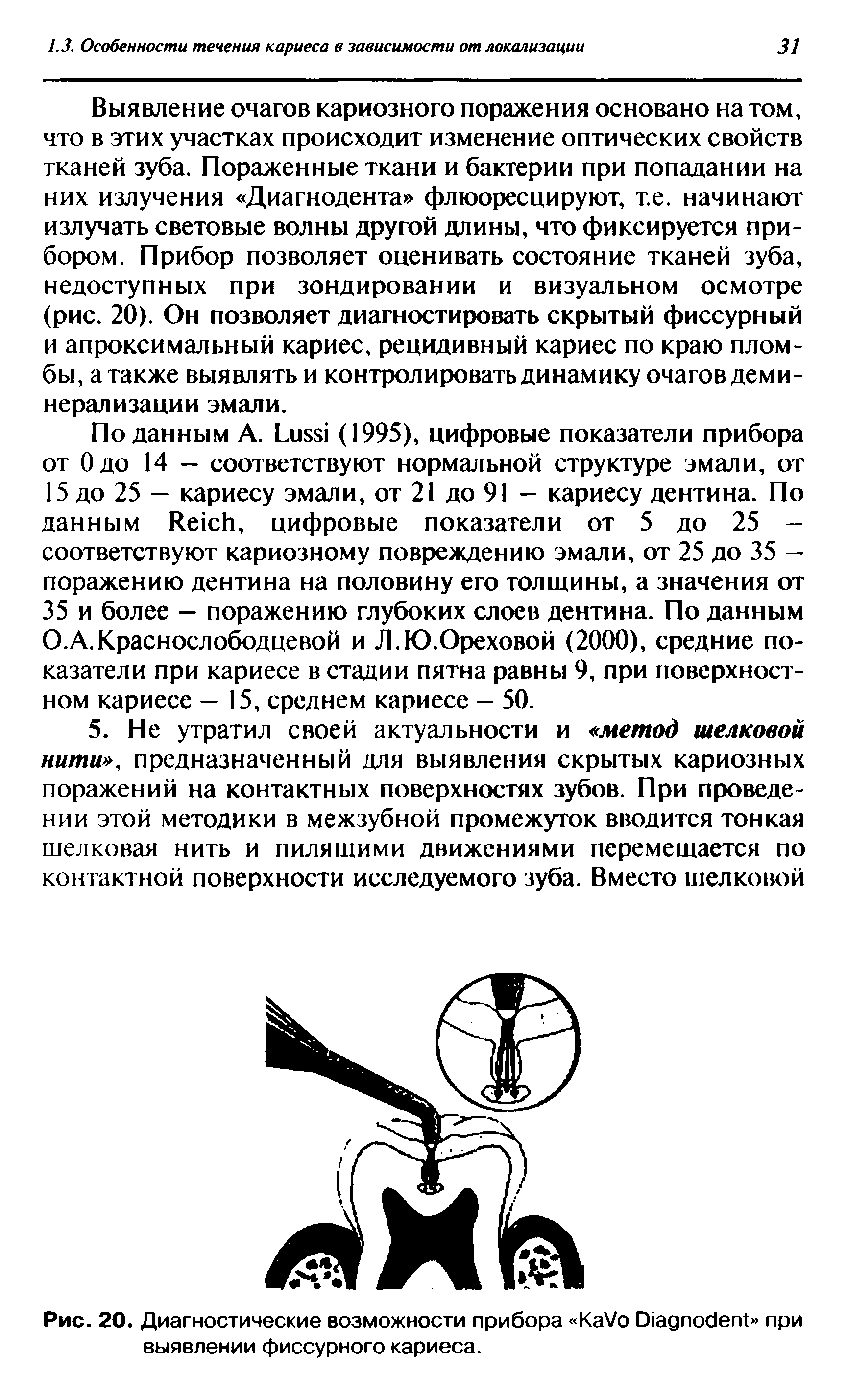 Рис. 20. Диагностические возможности прибора КаУо О1адпос1епЪ> при выявлении фиссурного кариеса.