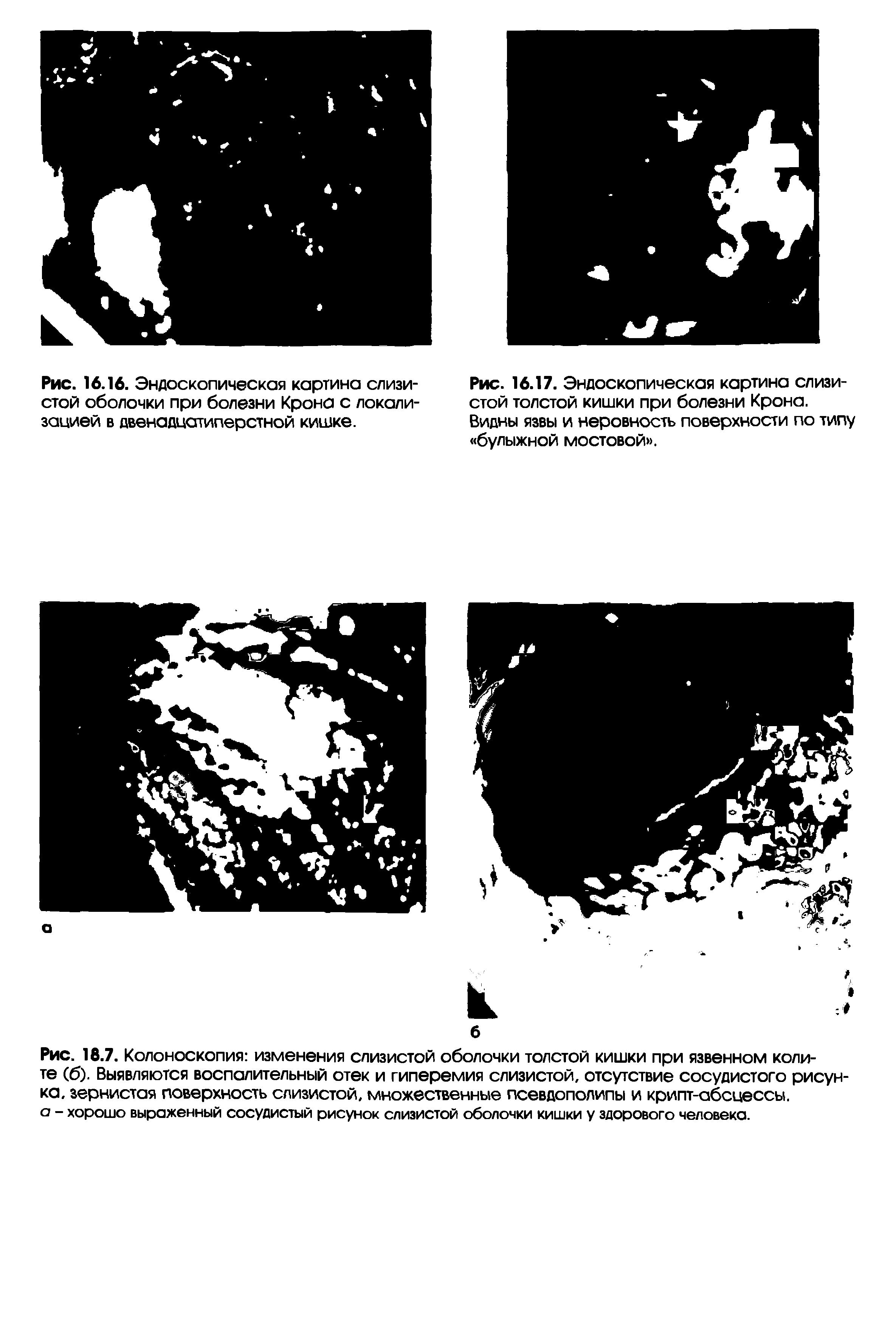Рис. 18.7. Колоноскопия изменения слизистой оболочки толстой кишки при язвенном колите (б). Выявляются воспалительный отек и гиперемия слизистой, отсутствие сосудистого рисунка, зернистая поверхность слизистой, множественные псевдополипы и крипт-абсцессы. а - хорошо выраженный сосудистый рисунок слизистой оболочки кишки у здорового человека.