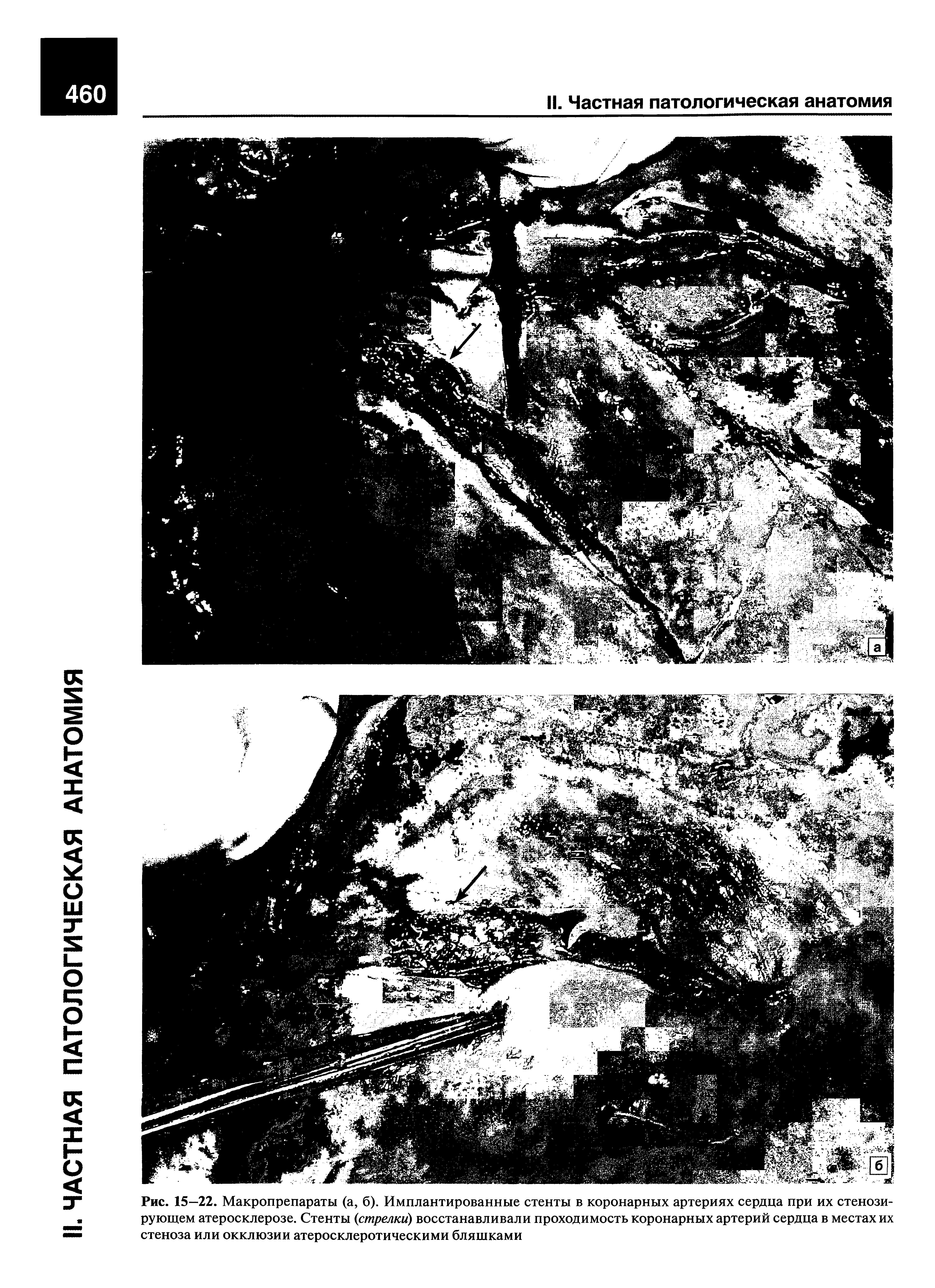 Рис. 15—22. Макропрепараты (а, б). Имплантированные стенты в коронарных артериях сердца при их стенозирующем атеросклерозе. Стенты (стрелки) восстанавливали проходимость коронарных артерий сердца в местах их стеноза или окклюзии атеросклеротическими бляшками...