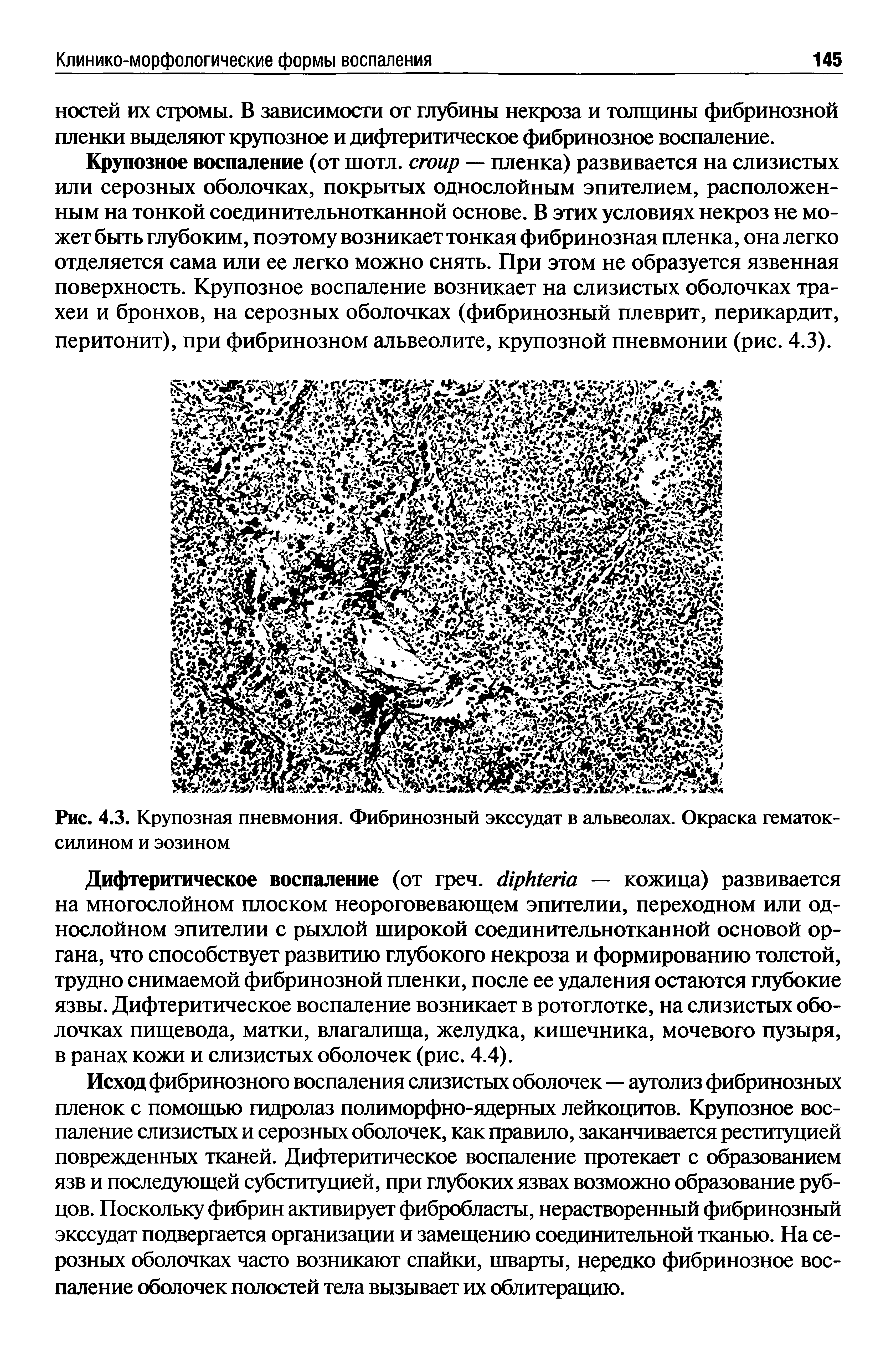 Рис. 4.3. Крупозная пневмония. Фибринозный экссудат в альвеолах. Окраска гематоксилином и эозином...