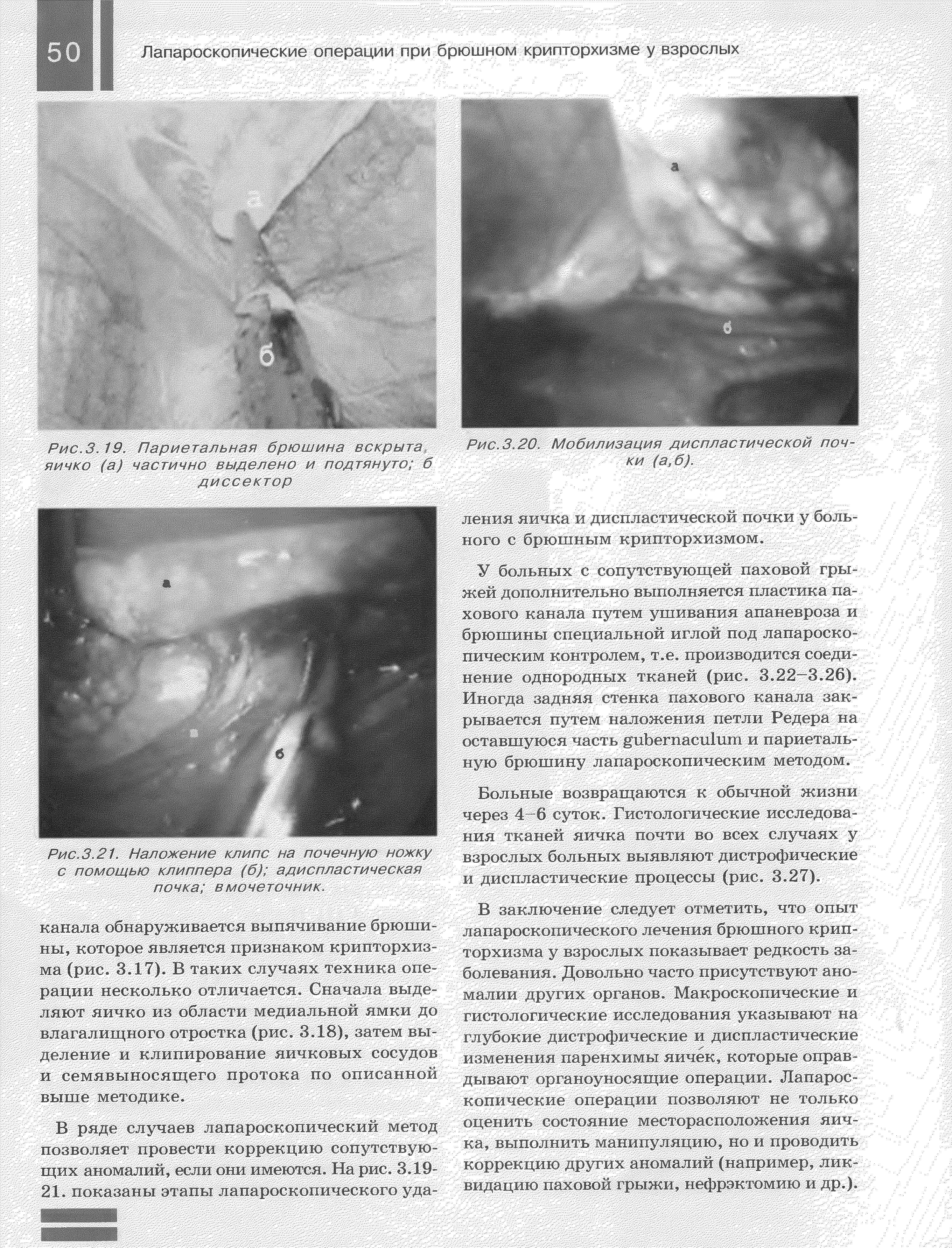 Рис. 3.20. Мобилизация диспластической поч-ления яичка и диспластической почки у боль-...