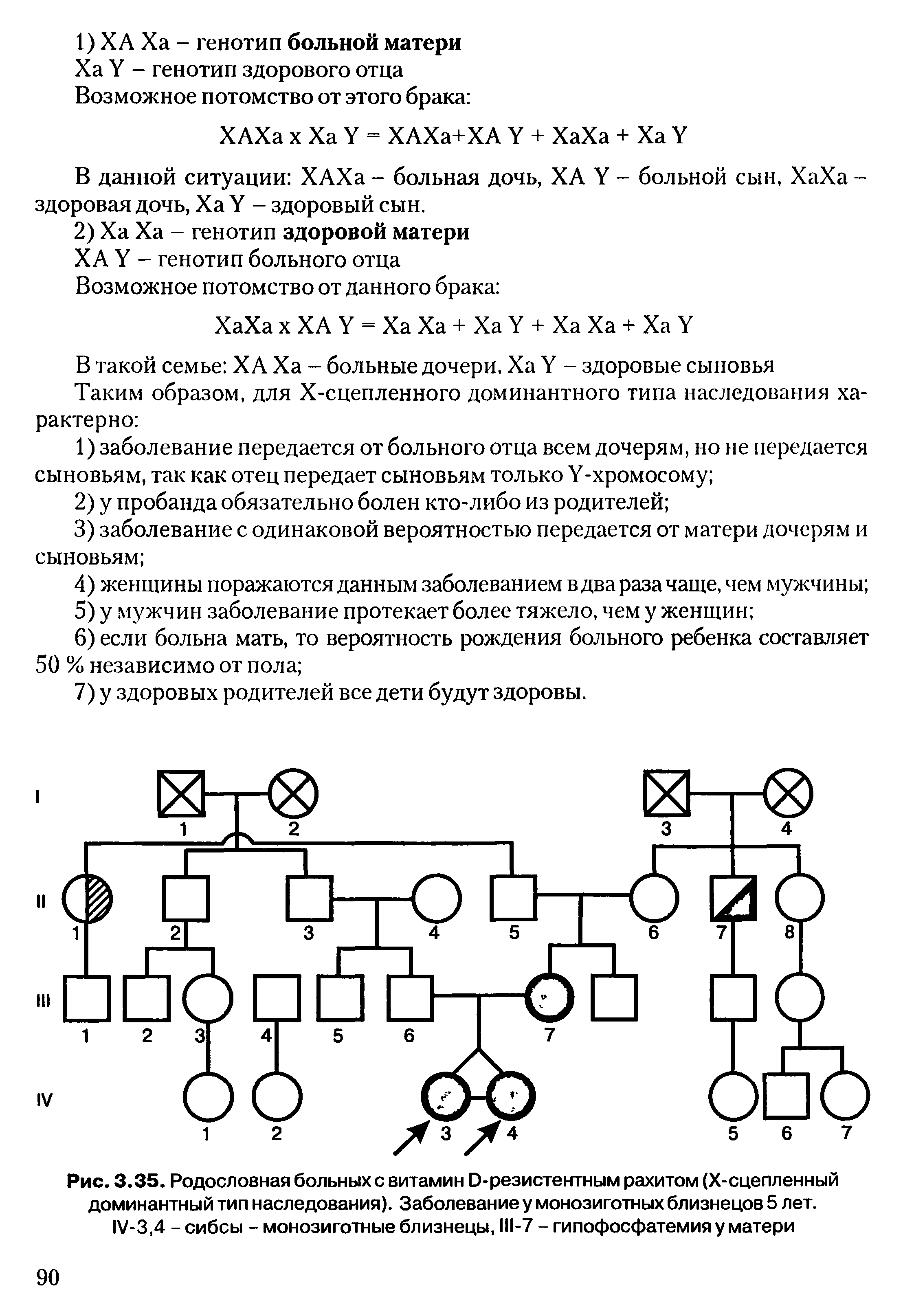 Рис. 3.35. Родословная больных с витамин Э-резистентным рахитом (Х-сцепленный доминантный тип наследования). Заболевание у монозиготных близнецов 5 лет. 1 /-3,4 - сибсы - монозиготные близнецы, 111-7 - гипофосфатемия у матери...