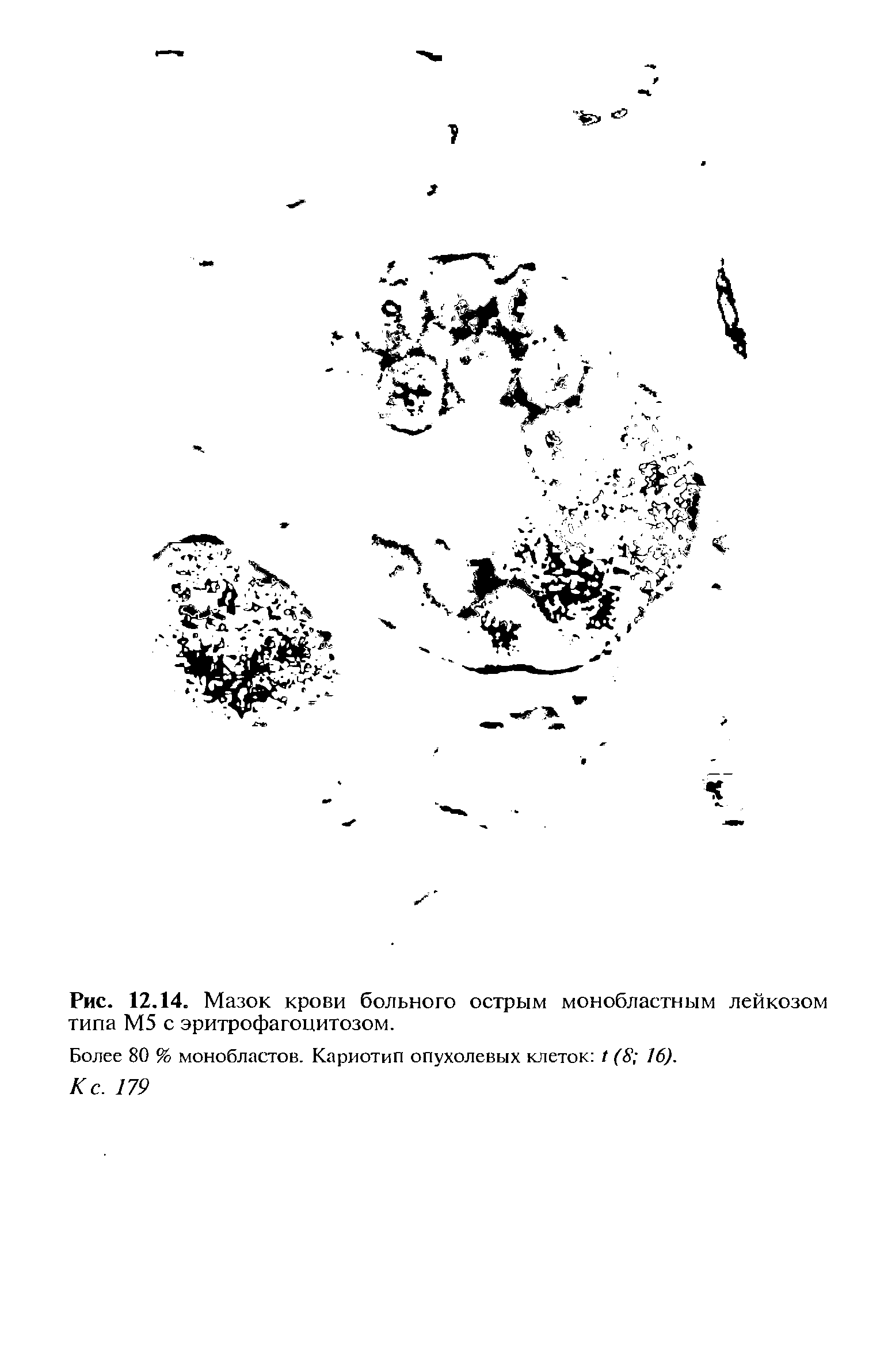 Рис. 12.14. Мазок крови больного острым монобластным лейкозом типа М5 с эритрофагоцитозом.