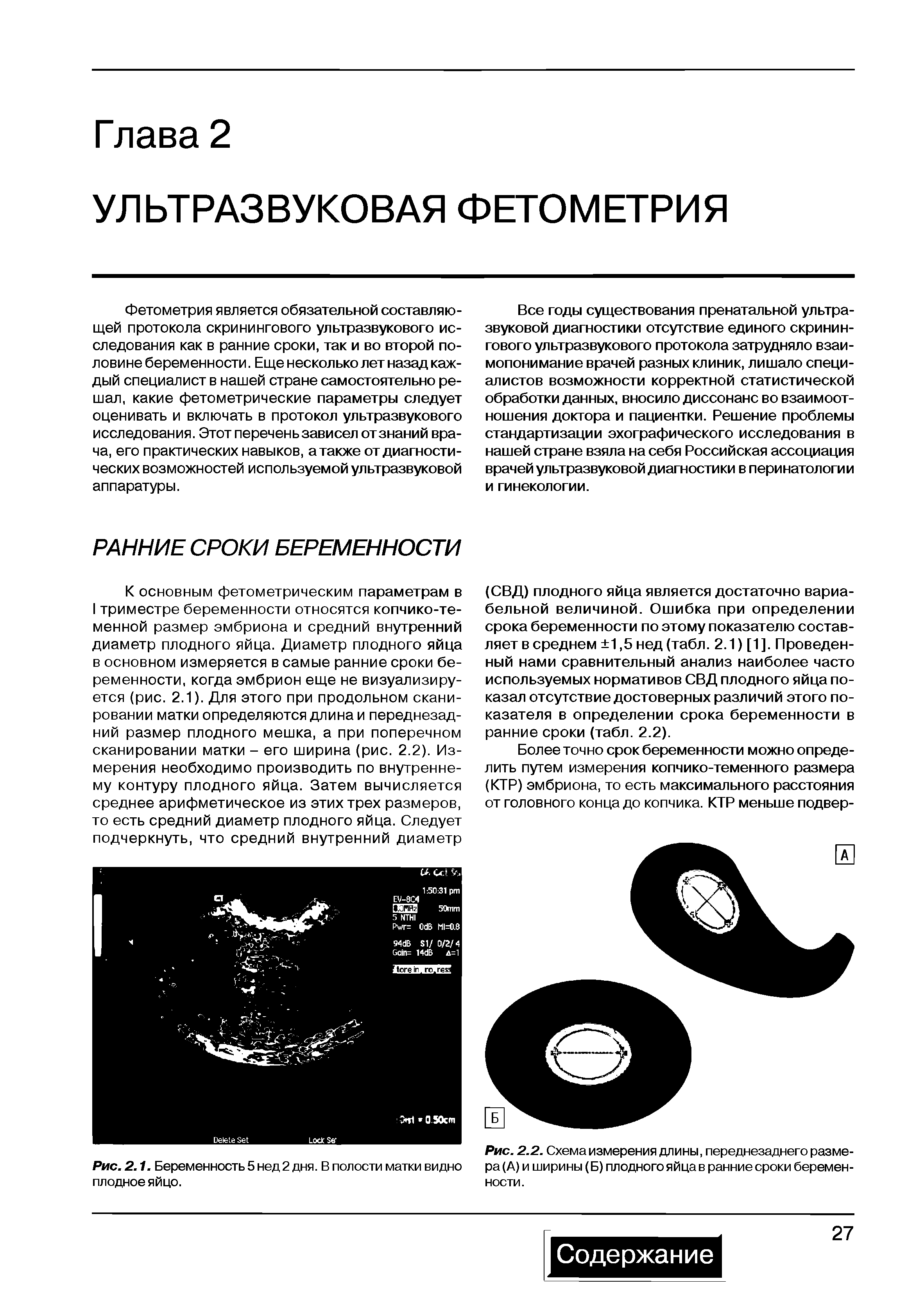 Рис. 2.2. Схема измерения длины, переднезаднего размера (А) и ширины (Б) плодного яйца в ранние сроки беременности.