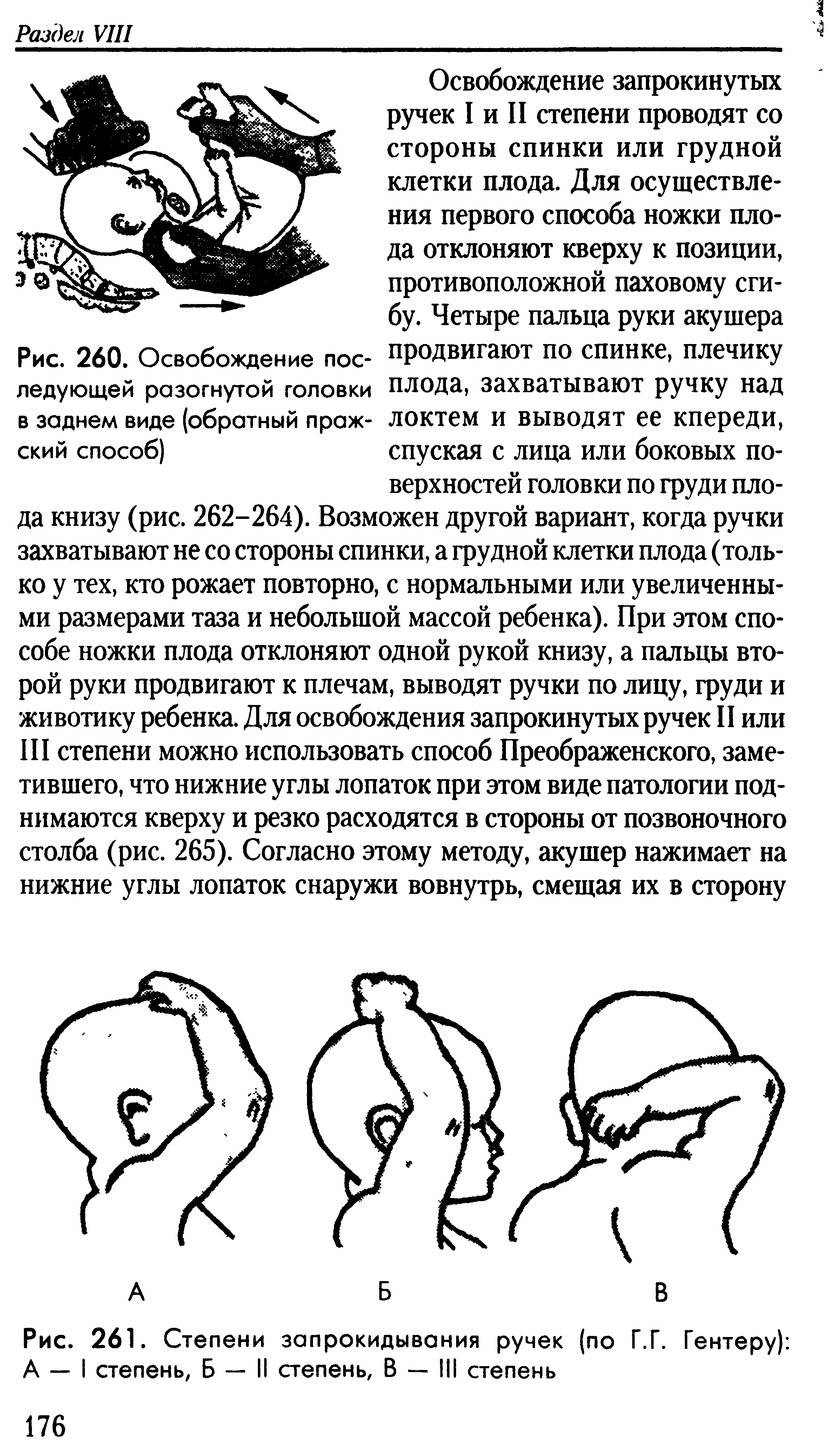 Рис. 261. Степени запрокидывания ручек (по Г.Г. Гентеру) А — I степень, Б — II степень, В — III степень...