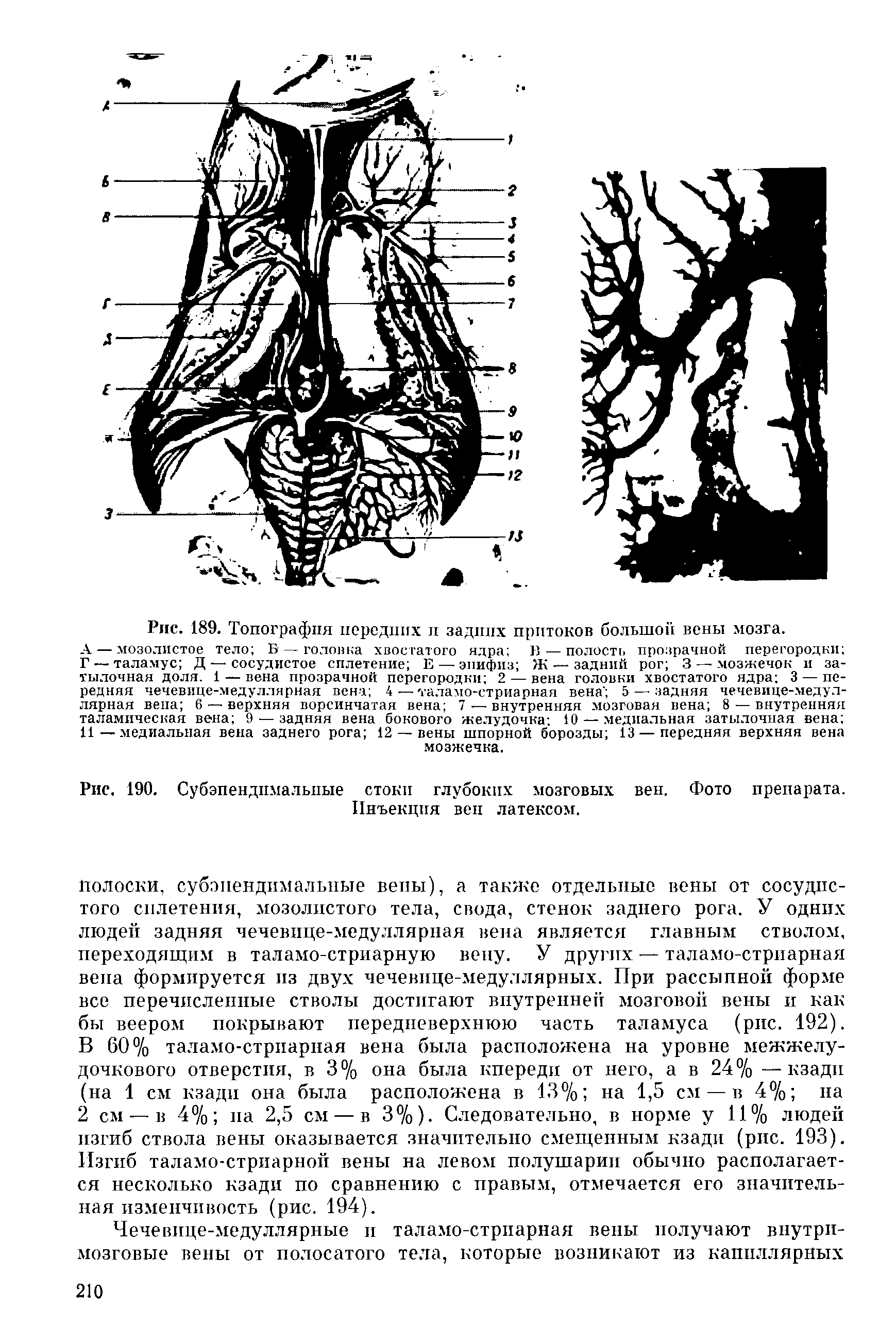 Рис. 190. Субэпендпмальпые стоки глубоких мозговых вен. Фото препарата. Инъекция вен латексом.