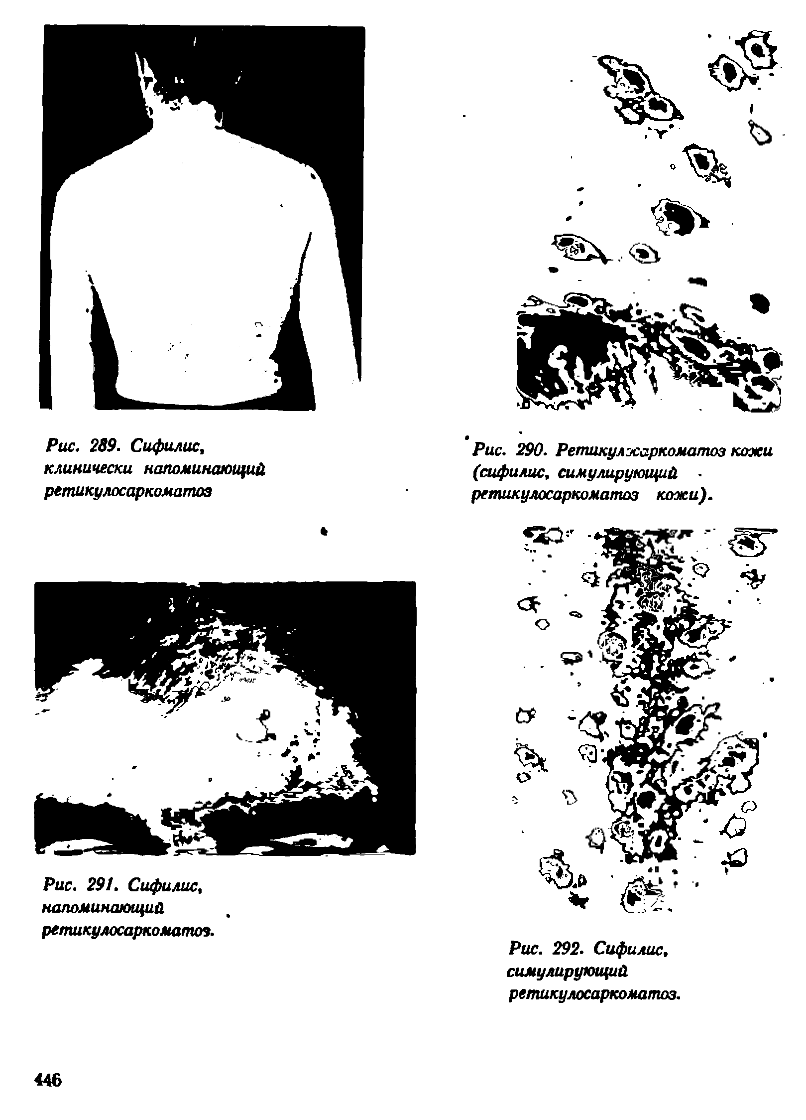Рис. 290. Ретикулжаркоматоз кожи (сифилис, симулирующий ретикулосаркоматоз кожи).