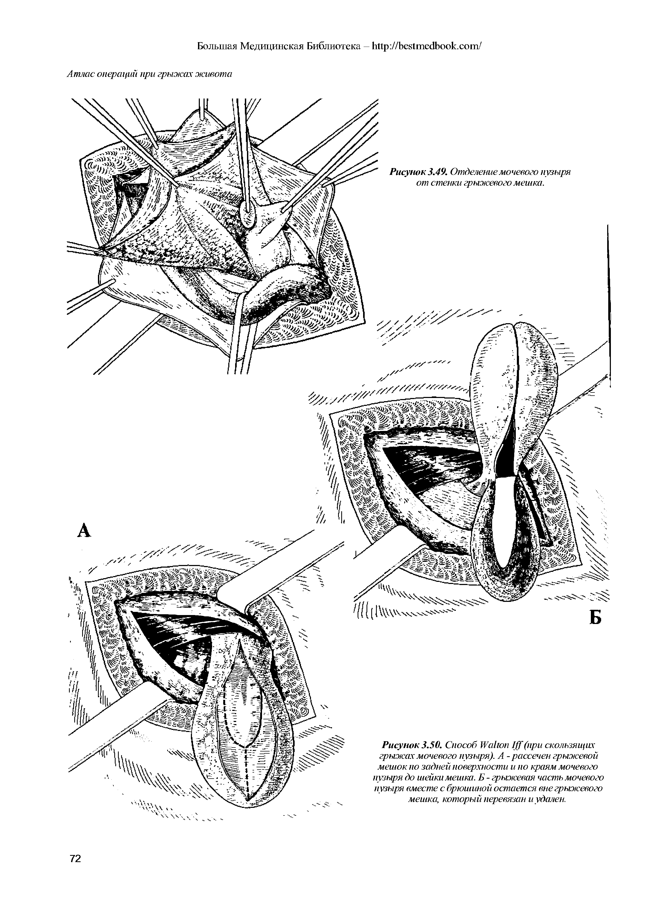 Рисунок 3.50. Способ W I (при скользящих грыжах мочевого пузыря). А - рассечен грыжевой мешок по задней поверхности и по краям мочевого пузыря до шейки мешка. Б - грыжевая часть мочевого пузыря вместе с брюшиной остается вне грыжевого мешка, который перевязан и удален.