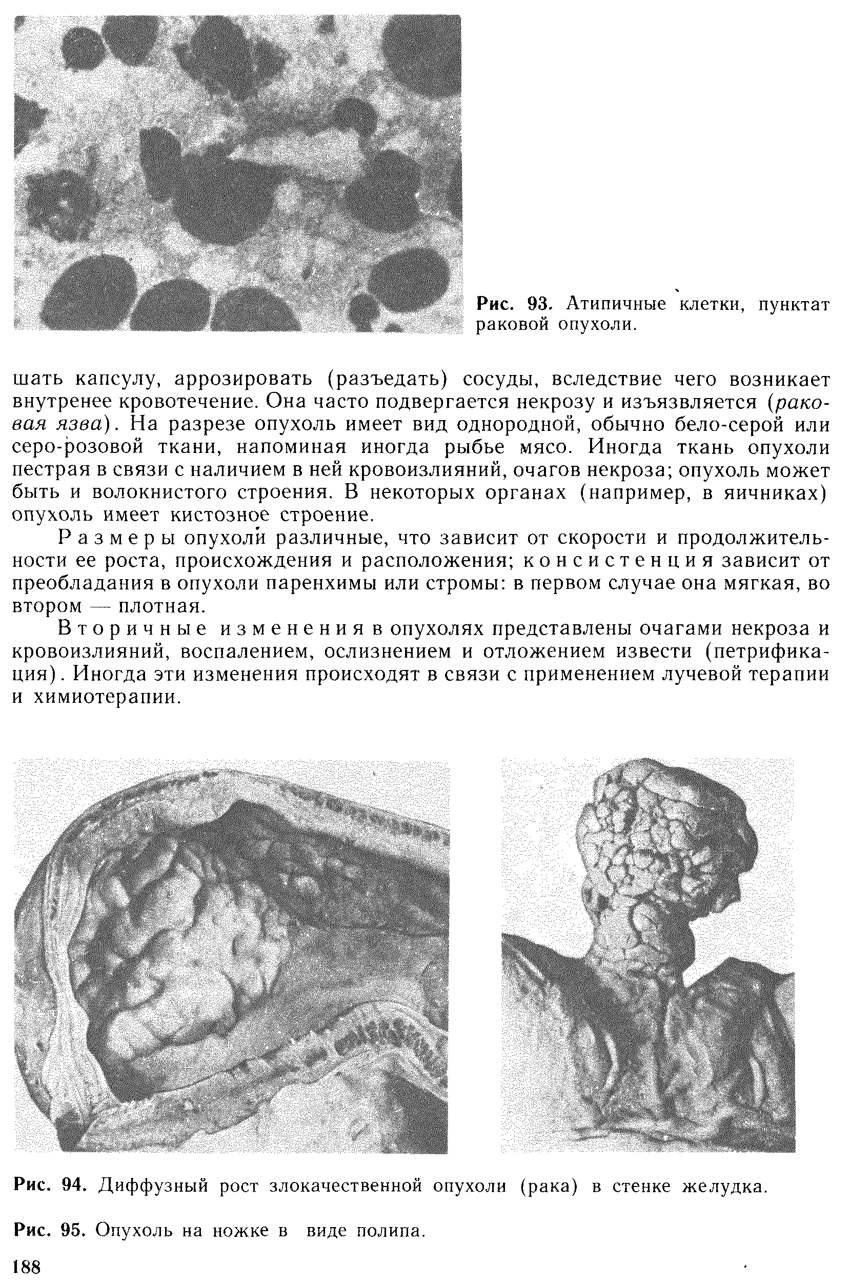 Рис. 94. Диффузный рост злокачественной опухоли (рака) в стенке желудка.