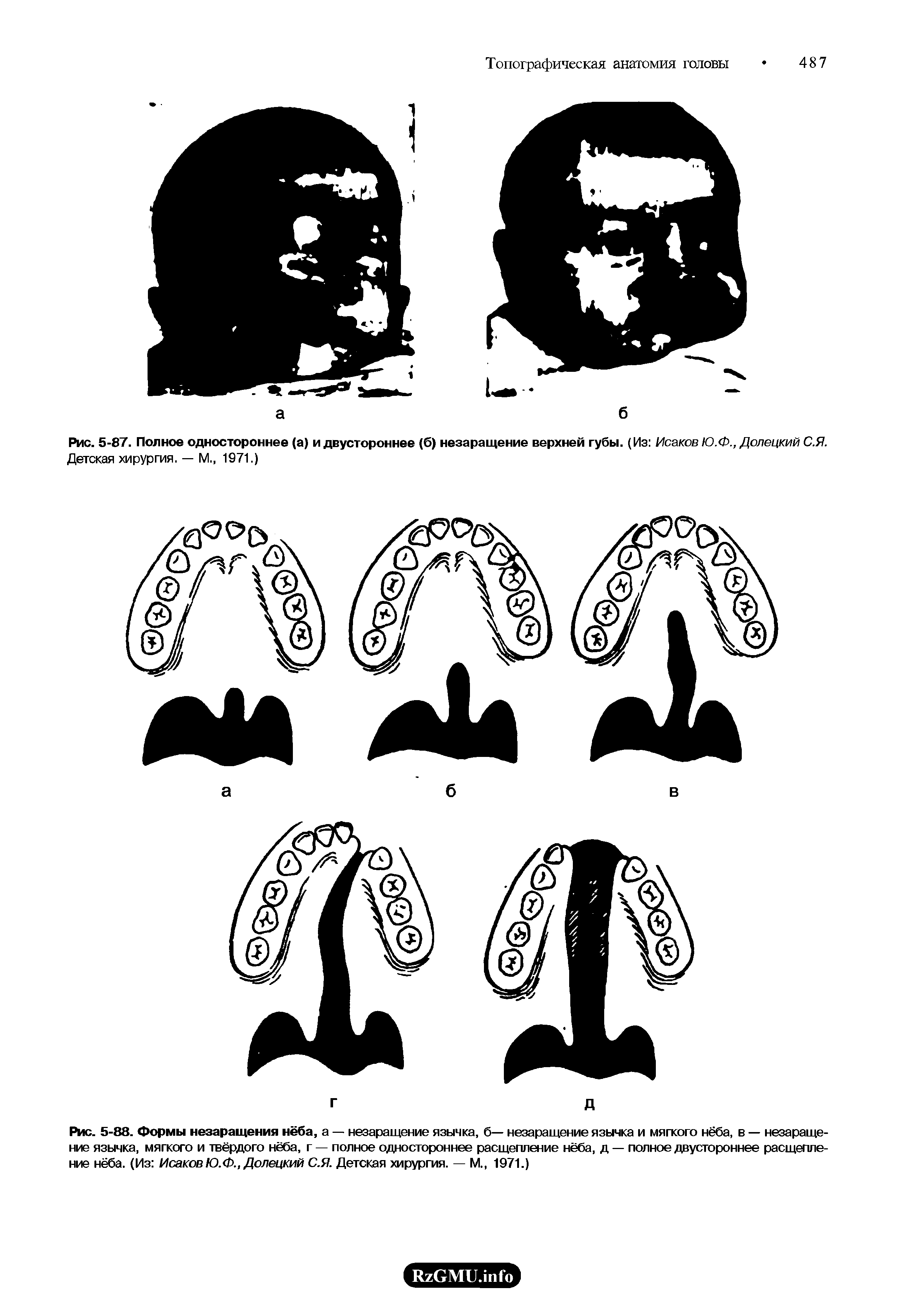 Рис. 5-87. Полное одностороннее (а) и двустороннее (б) незаращение верхней губы. (Из Исаков Ю.Ф., Долецкий С.Я. Детская хирургия. — М., 1971.)...