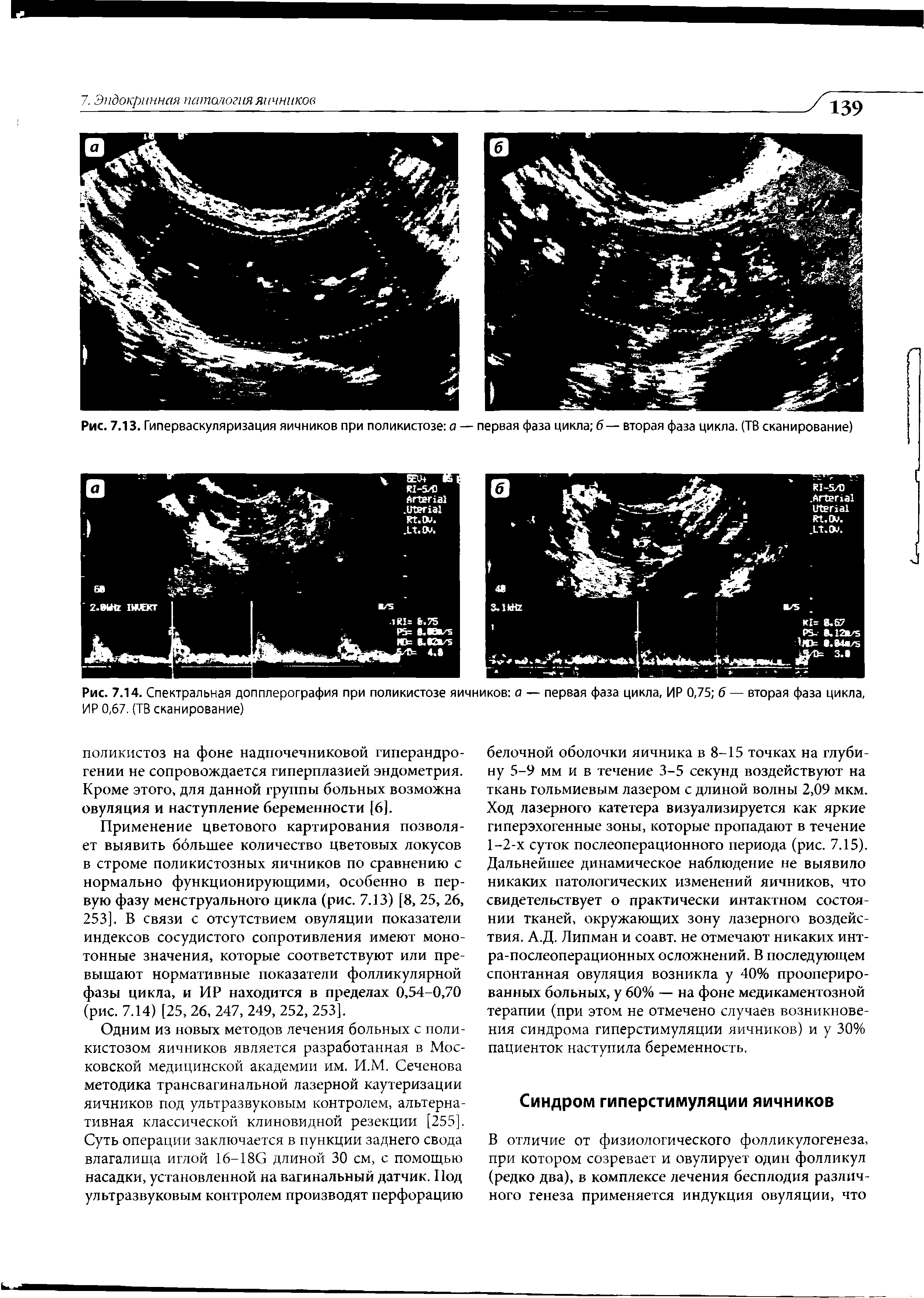 Рис. 7.14. Спектральная допплерография при поликистозе яичников а — первая фаза цикла, ИР 0,75 б — вторая фаза цикла, ИР 0,67. (ТВ сканирование)...