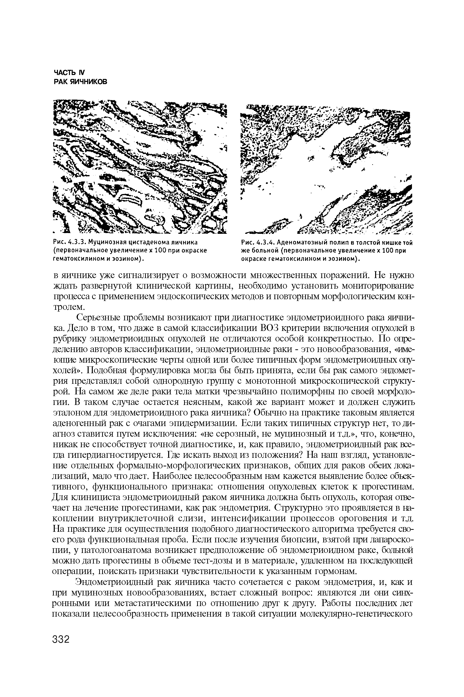 Рис. 4.3.4. Аденоматозный полип в толстой кишке той же больной (первоначальное увеличение х 100 при окраске гематоксилином и эозином).