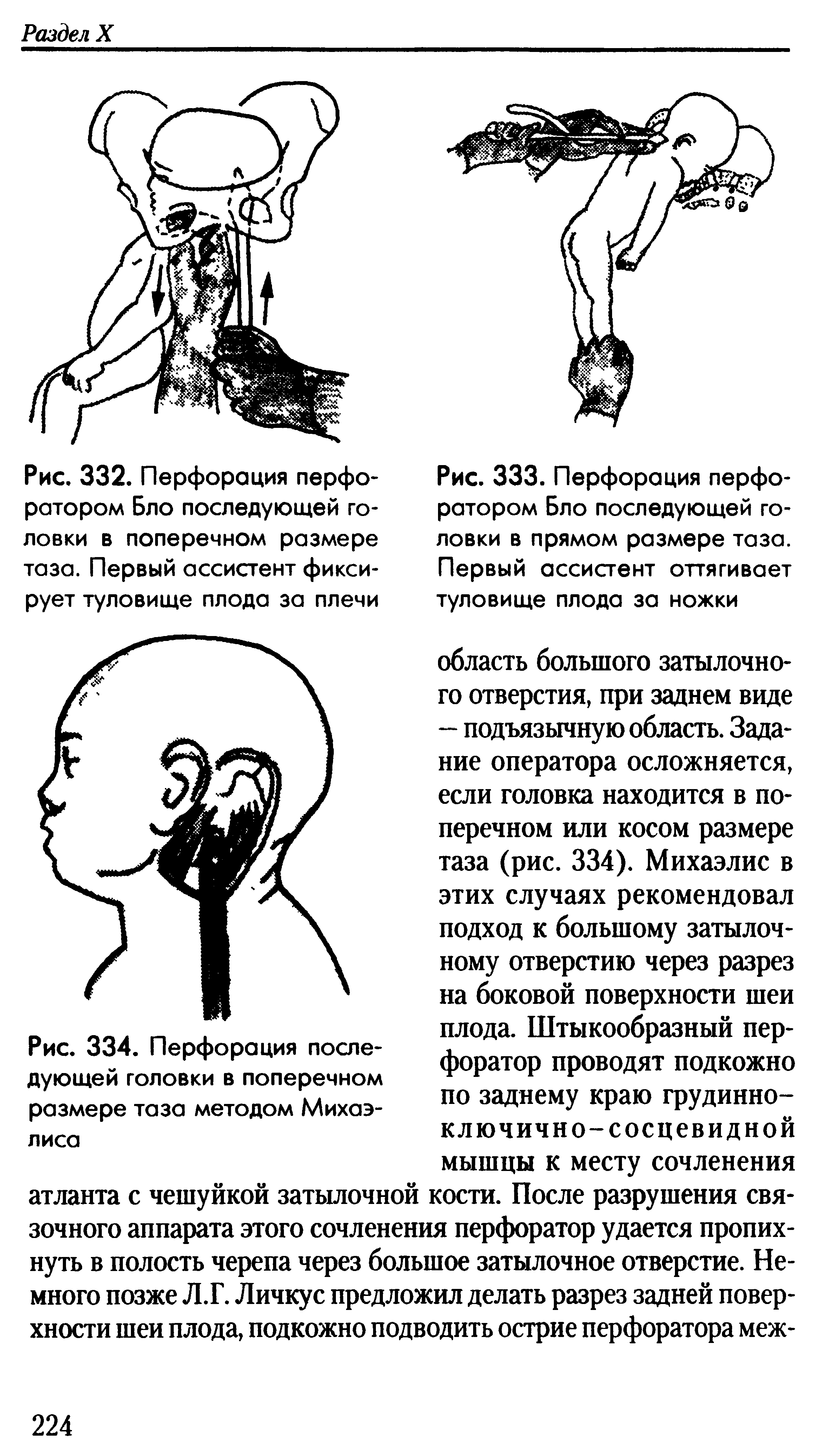 Рис. 334. Перфорация последующей головки в поперечном размере таза методом Михаэлиса...