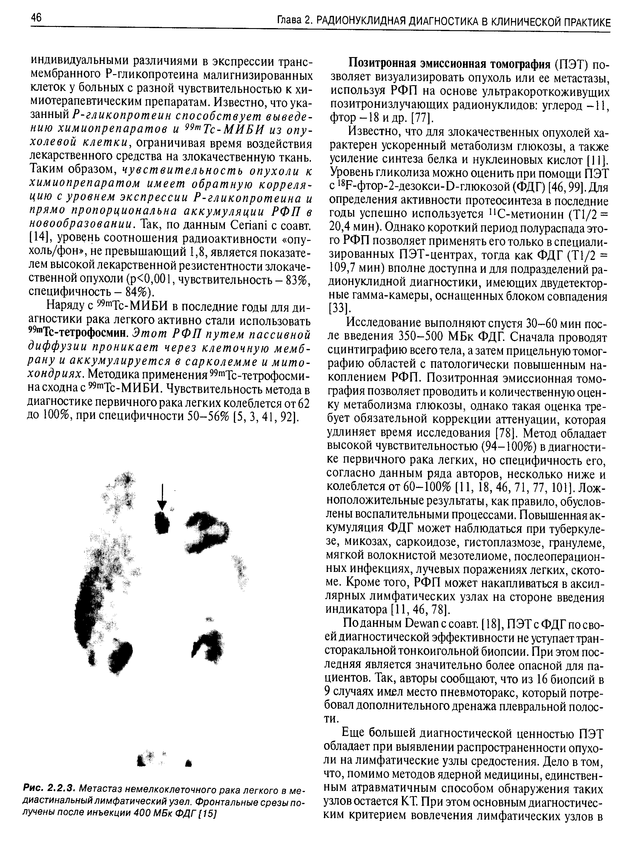 Рис. 2.2.3. Метастаз немелкоклеточного рака легкого в медиастинальный лимфатический узел. Фронтальные срезы получены после инъекции 400 МБк ФДГ [15]...