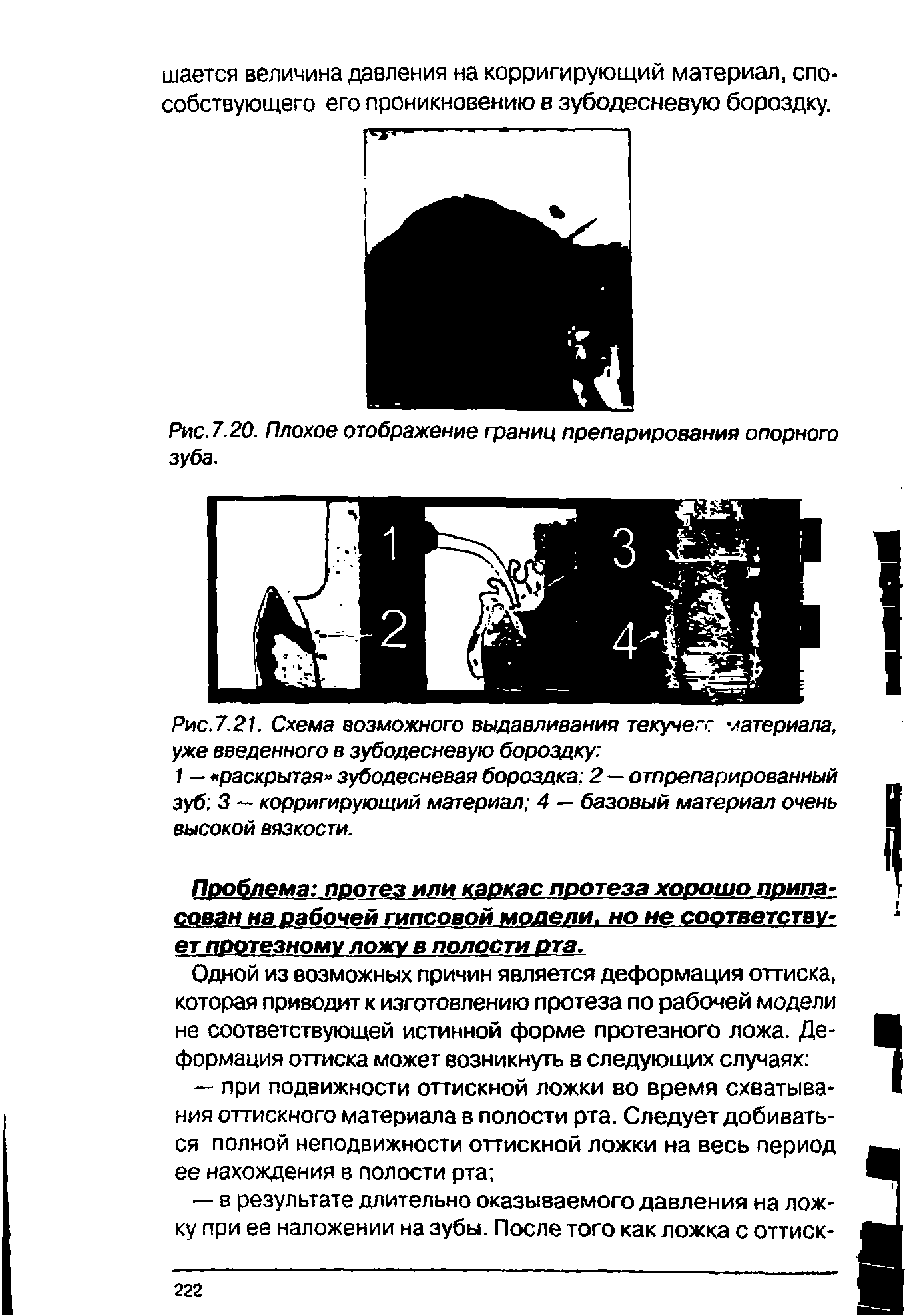 Рис. 7.20. Плохое отображение границ препарирования опорного зуба.