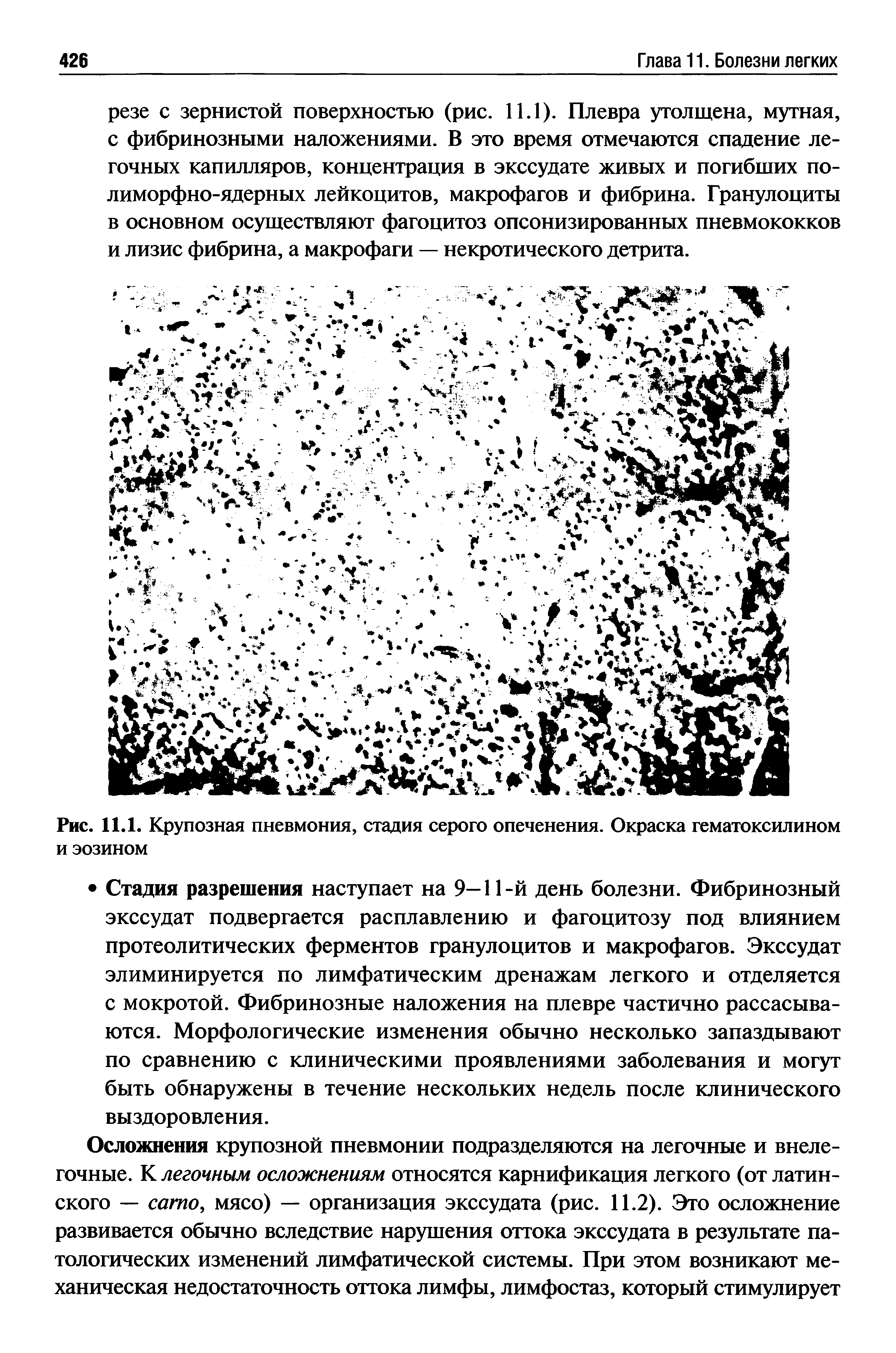 Рис. 11.1. Крупозная пневмония, стадия серого опеченения. Окраска гематоксилином и эозином...