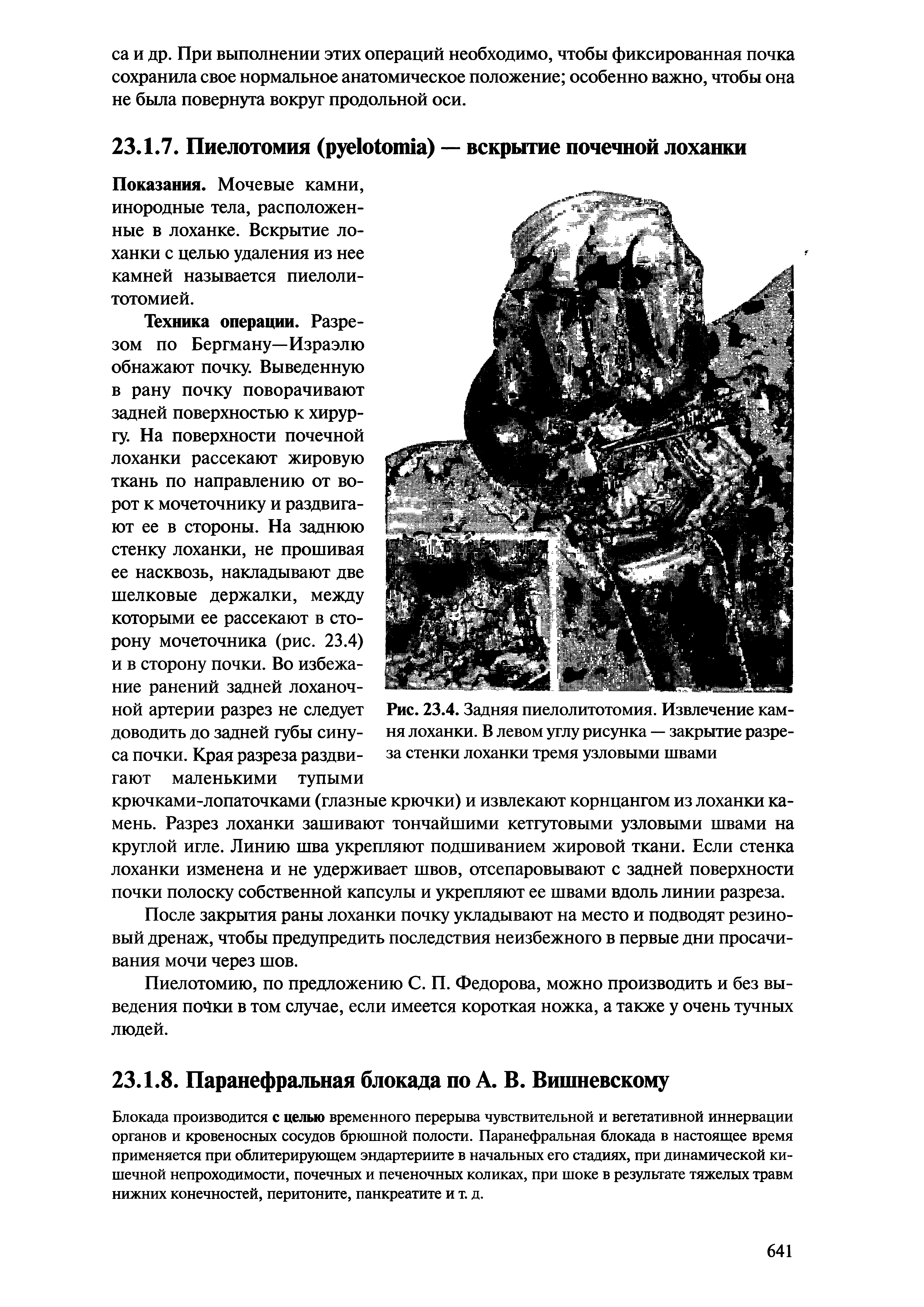 Рис. 23.4. Задняя пиелолитотомия. Извлечение камня лоханки. В левом углу рисунка — закрытие разреза стенки лоханки тремя узловыми швами...