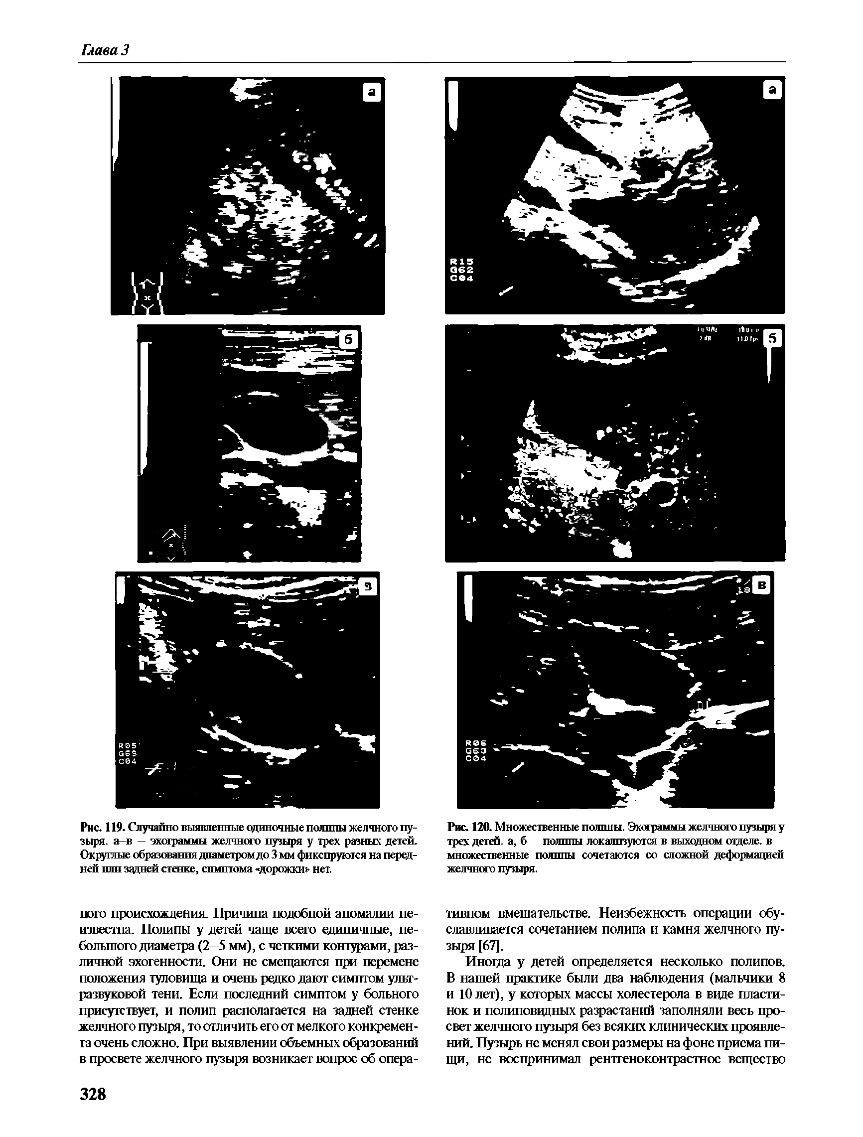 Рис. 120. Множественные полипы. Эхограммы желчного пузыря у трех детей, а, б полипы локализуются в выходном отделе, в множественные полипы сочетаются со сложной деформацией желчного пузыря.
