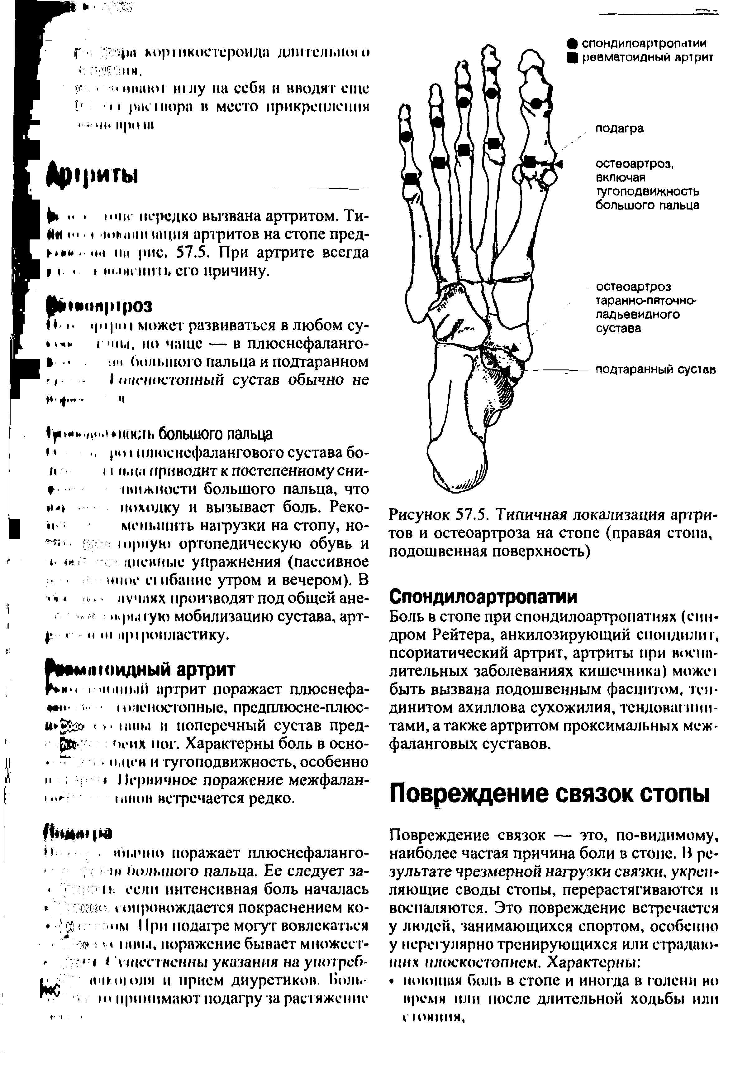 Рисунок 57.5. Типичная локализация артритов и остеоартроза на стопе (правая стопа, подошвенная поверхность)...