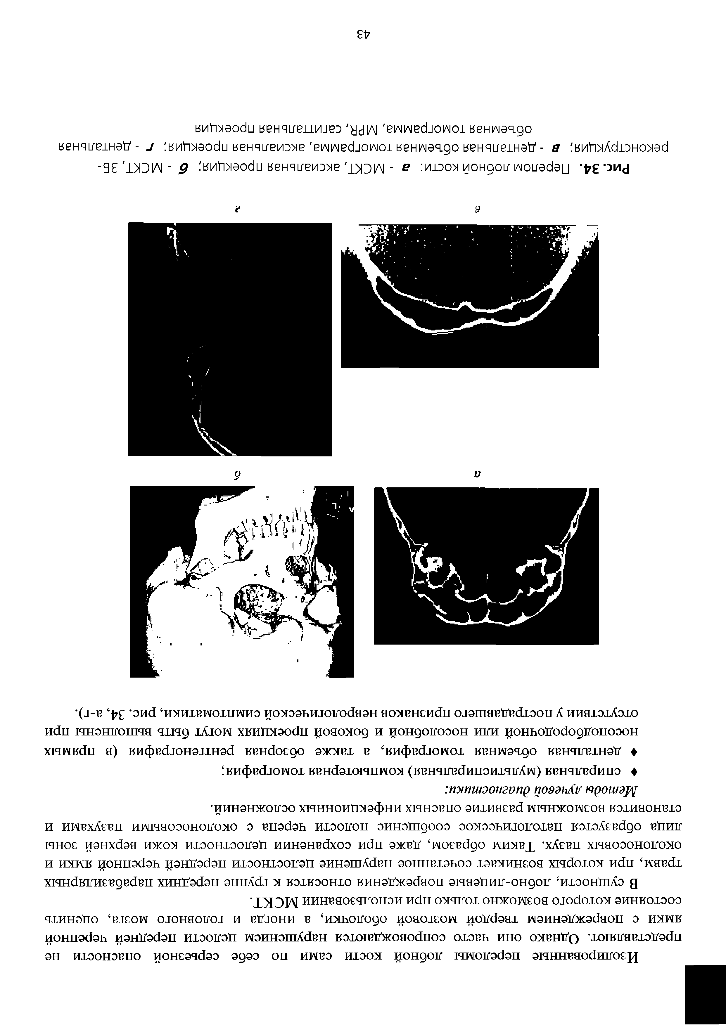 Рис. 34. Перелом лобной кости а - МСКТ, аксиальная проекция б - МСКТ, ЗБ-реконструкция в - дентальная объемная томограмма, аксиальная проекция г-дентальная объемная томограмма, МРИ, сагиттальная проекция...
