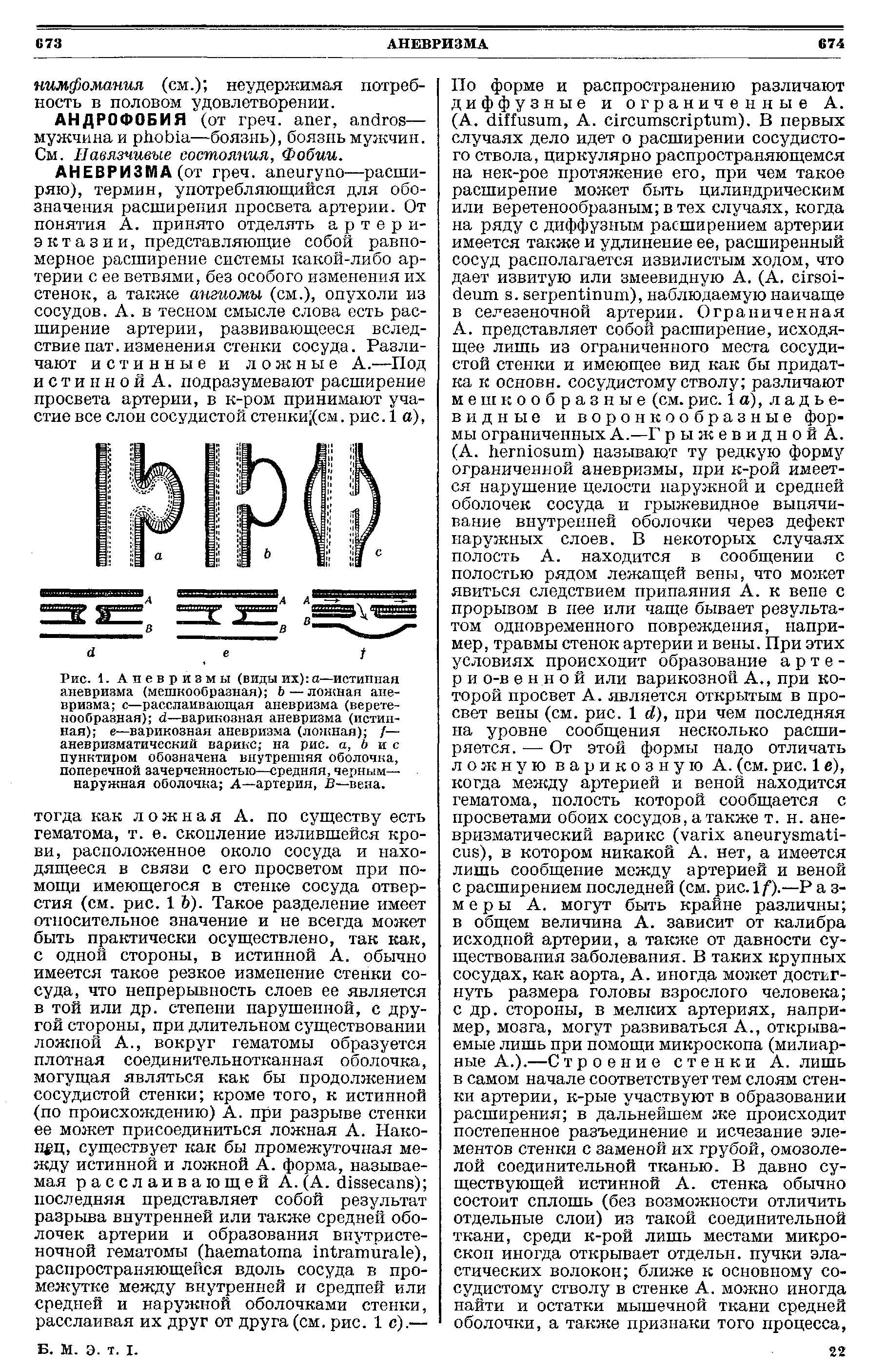 Рис. 1. Аневризмы (виды их) а—истинная аневризма (мешкообразная) Ь — ложная аневризма с—расслаивающая аневризма (веретенообразная) —варикозная аневризма (истинная) е—варикозная аневризма (ложная) /— аневризматический варикс на рис. а, б и с пунктиром обозначена внутренняя оболочка, поперечной зачерченностыо—средняя, черным— наружная оболочка А—артерия, В—вена.