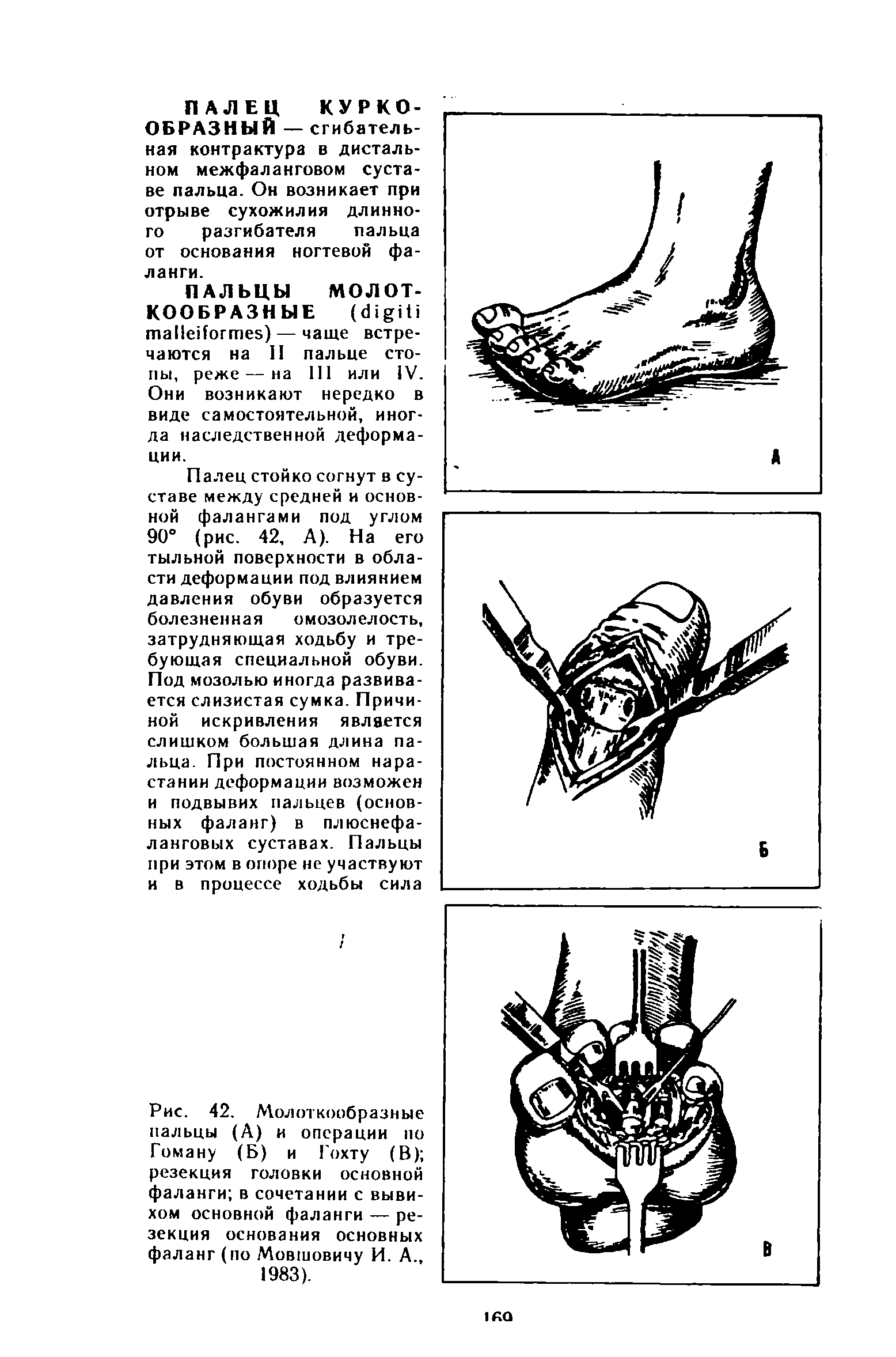 Рис. 42. Молоткообразные пальцы (А) и операции но Гоману (Б) и Гохту (В) резекция головки основной фаланги в сочетании с вывихом основной фаланги — резекция основания основных фаланг (по Мовшовичу И. А., 1983).