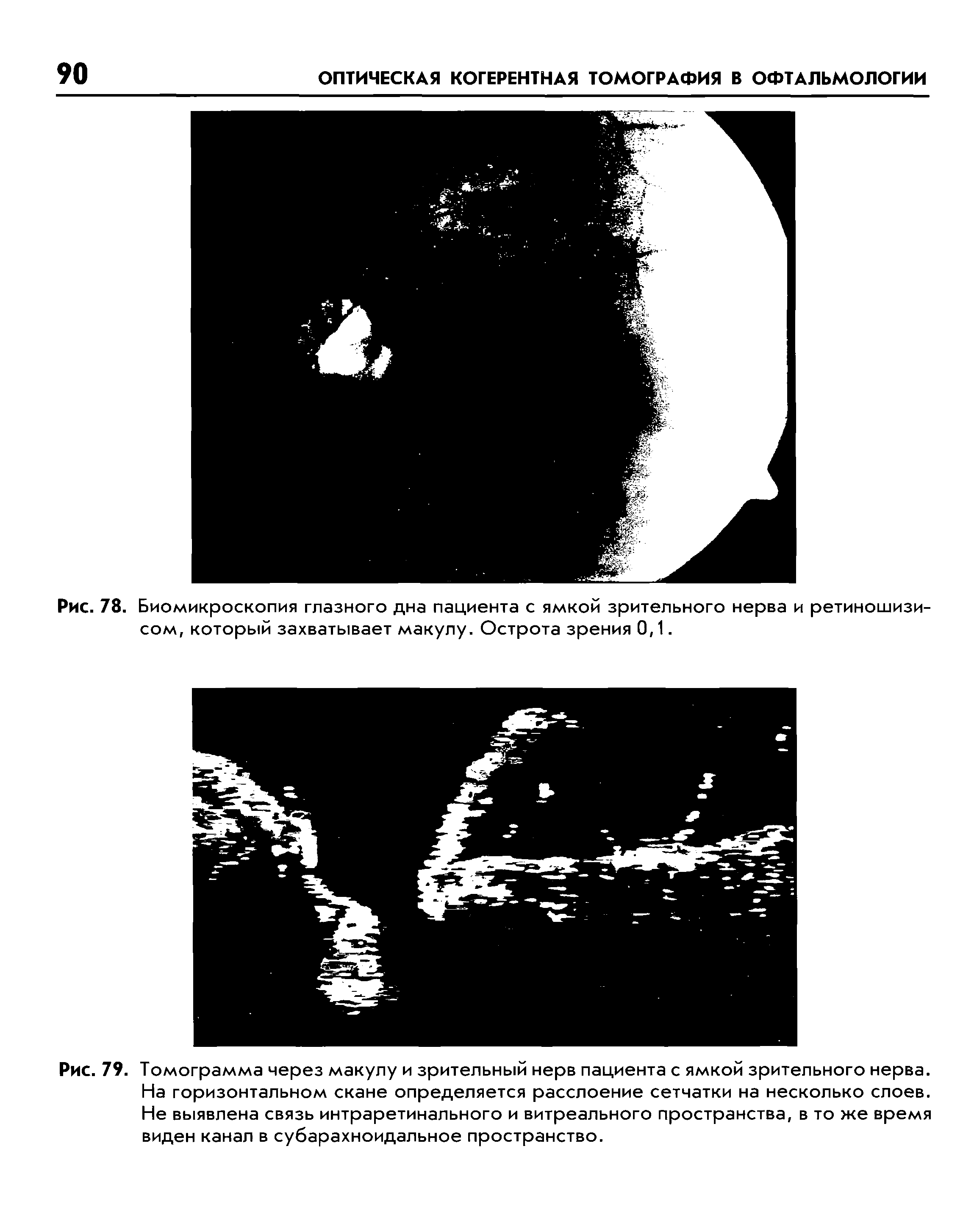 Рис. 79. Томограмма через макулу и зрительный нерв пациента с ямкой зрительного нерва. На горизонтальном скане определяется расслоение сетчатки на несколько слоев. Не выявлена связь интраретинального и витреального пространства, в то же время виден канал в субарахноидальное пространство.