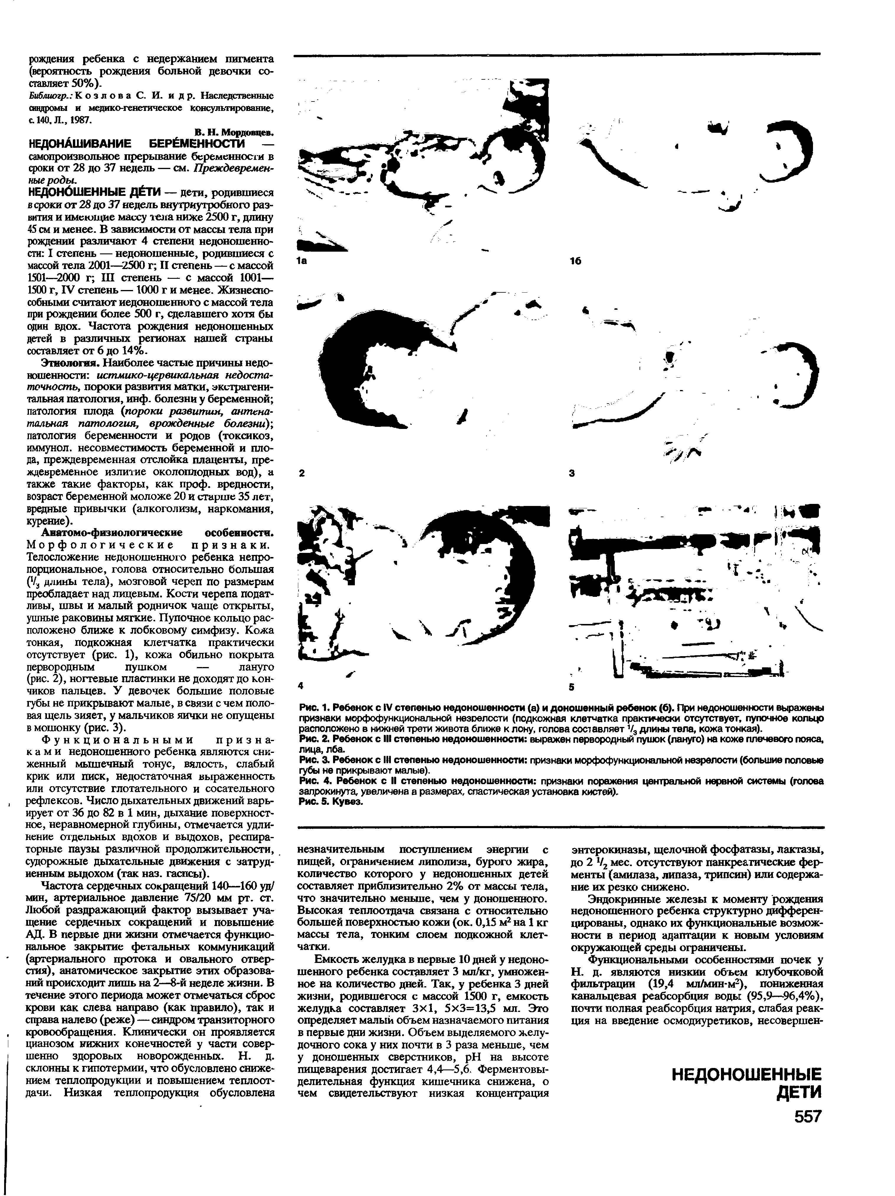 Рис. 3. Ребенок с III степенью недоношенности признаки морфофункциональной незрелости (большие половые губы не прикрывают малые).