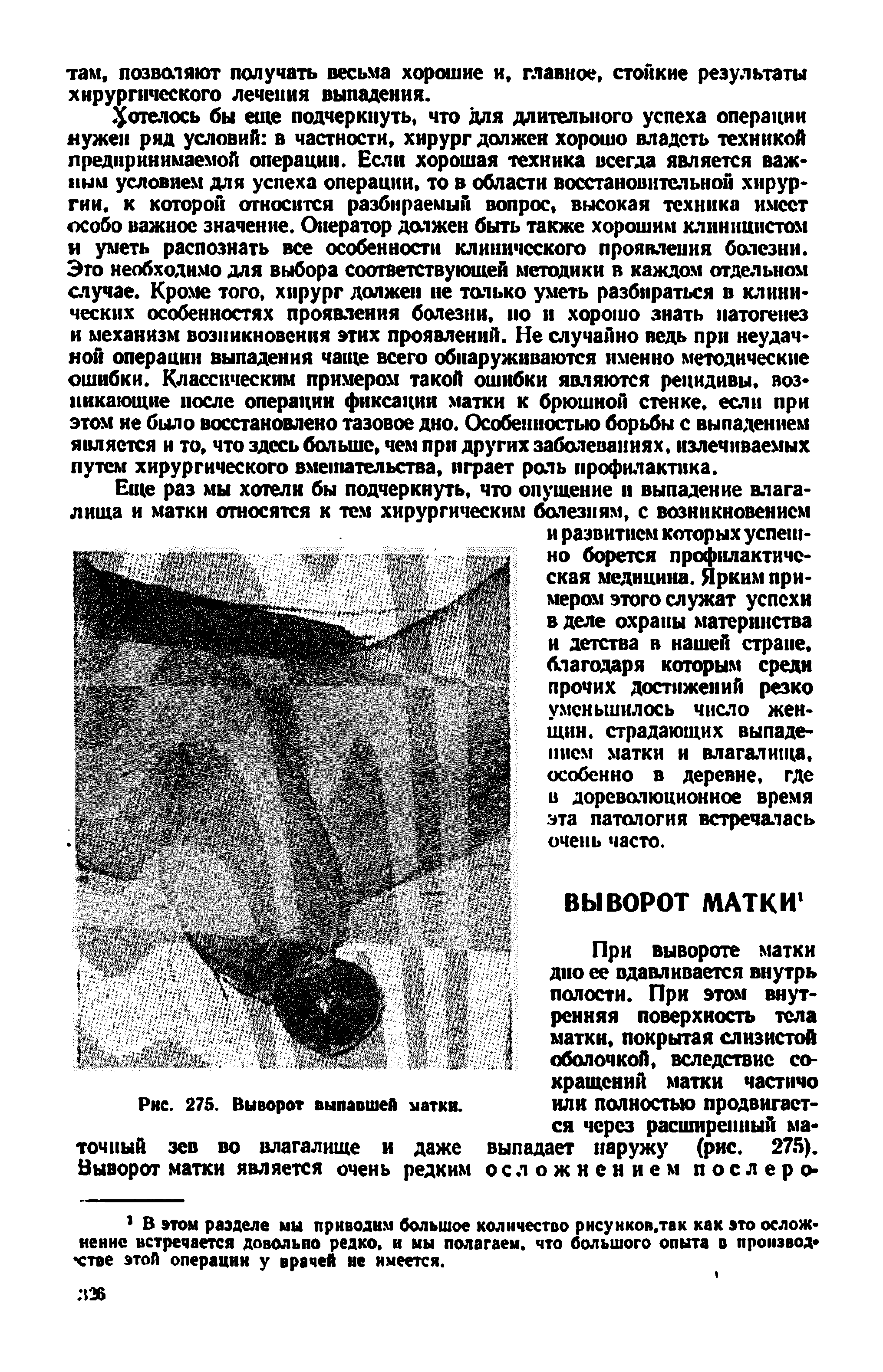 Рис. 275. Выворот выпавшей матки, точный зев во влагалище и даже Выворот матки является очень редким...