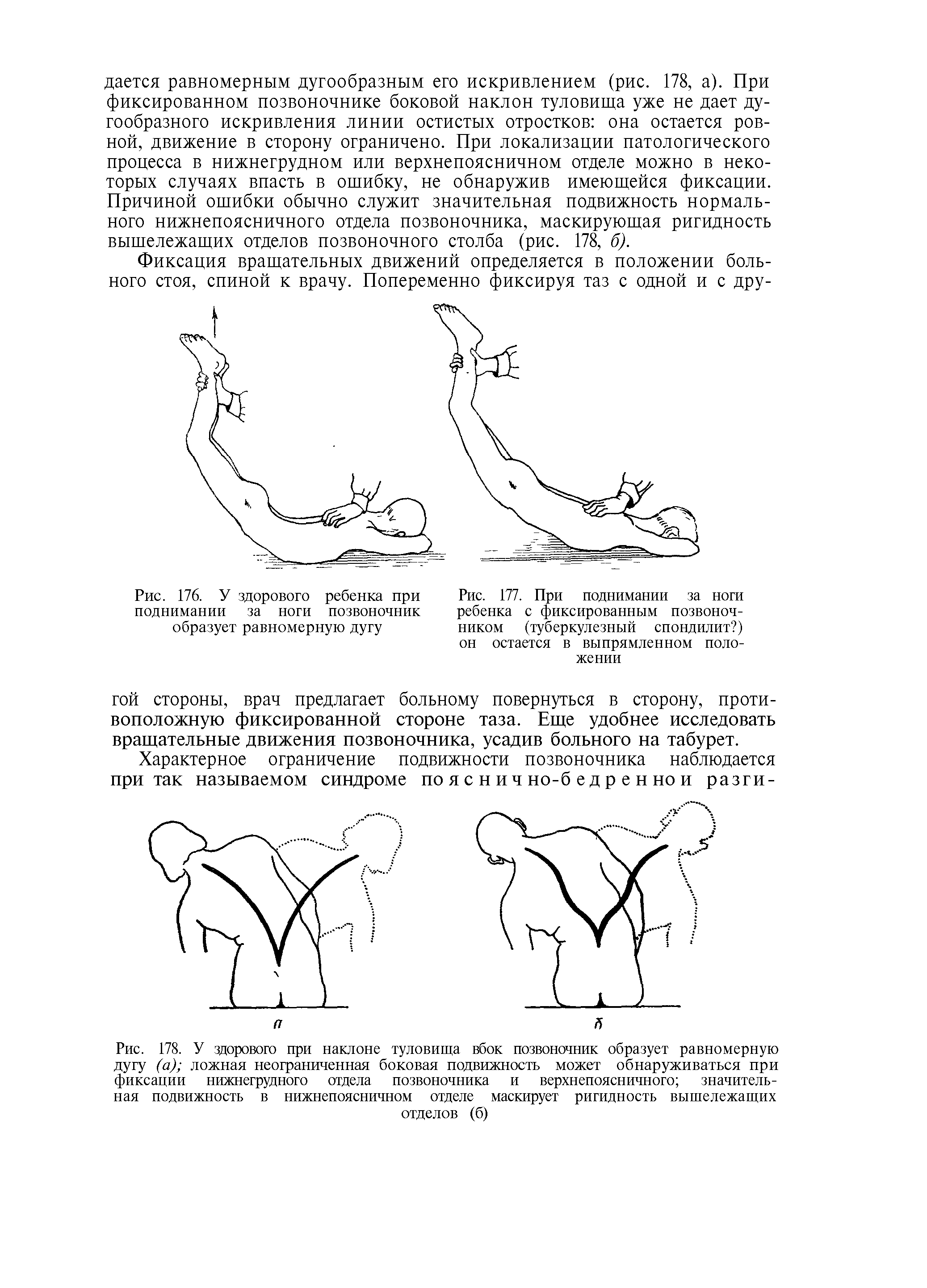 Рис. 177. При поднимании за ноги ребенка с фиксированным позвоночником (туберкулезный спондилит ) он остается в выпрямленном положении...