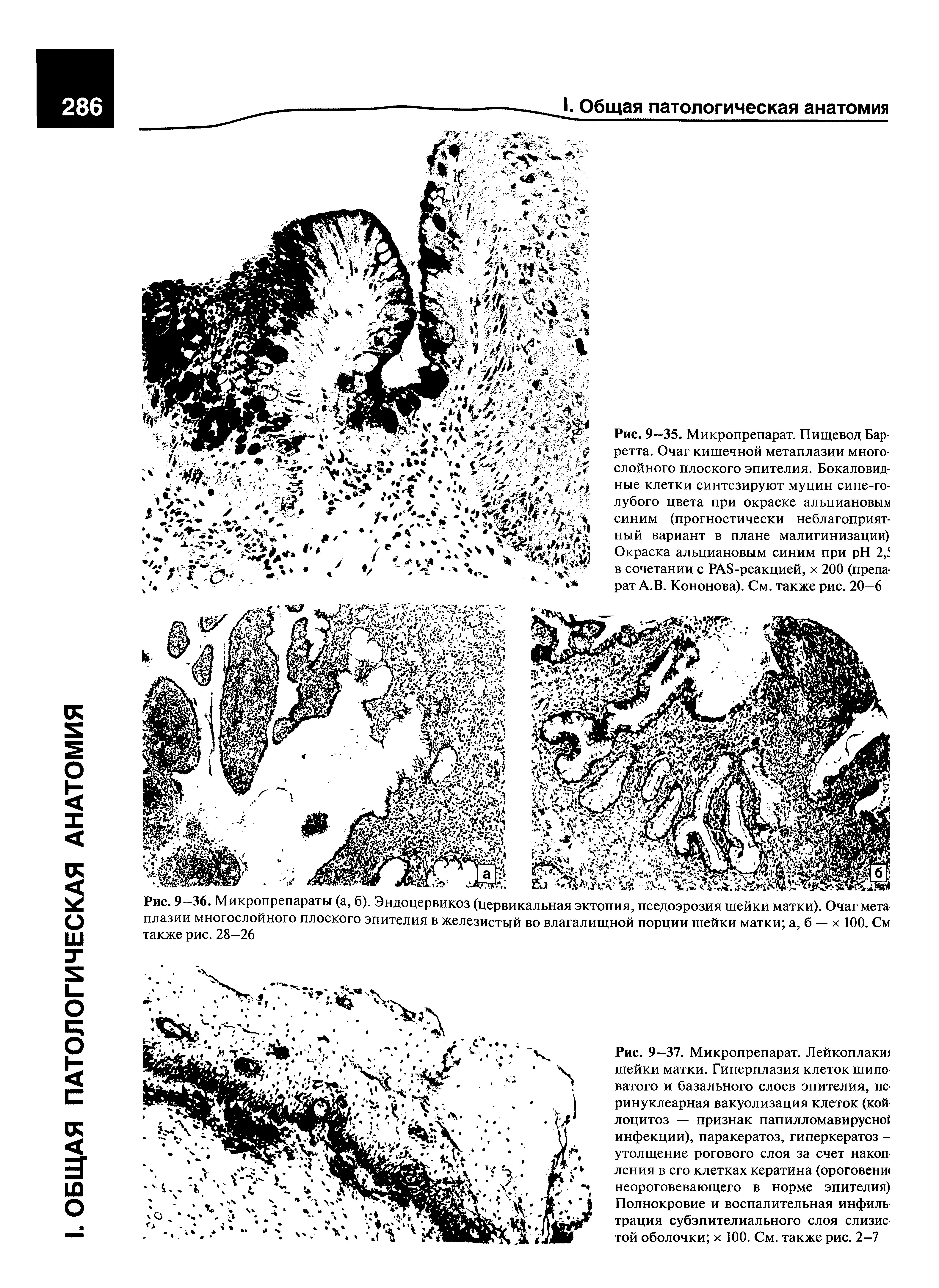 Рис. 9—36. Микропрепараты (а, б). Эндоцервикоз (цервикальная эктопия, пседоэрозия шейки матки). Очаг мета плазии многослойного плоского эпителия в железистый во влагалищной порции шейки матки а, б —- х 100. См также рис. 28—26...